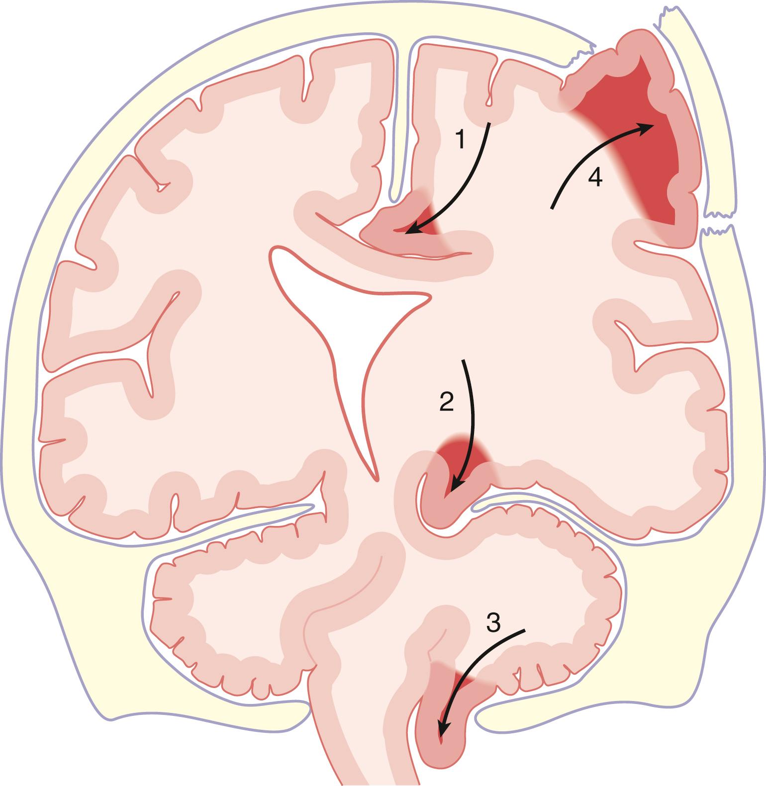 Fig. 57.1, Schematic representation of various herniation pathways.