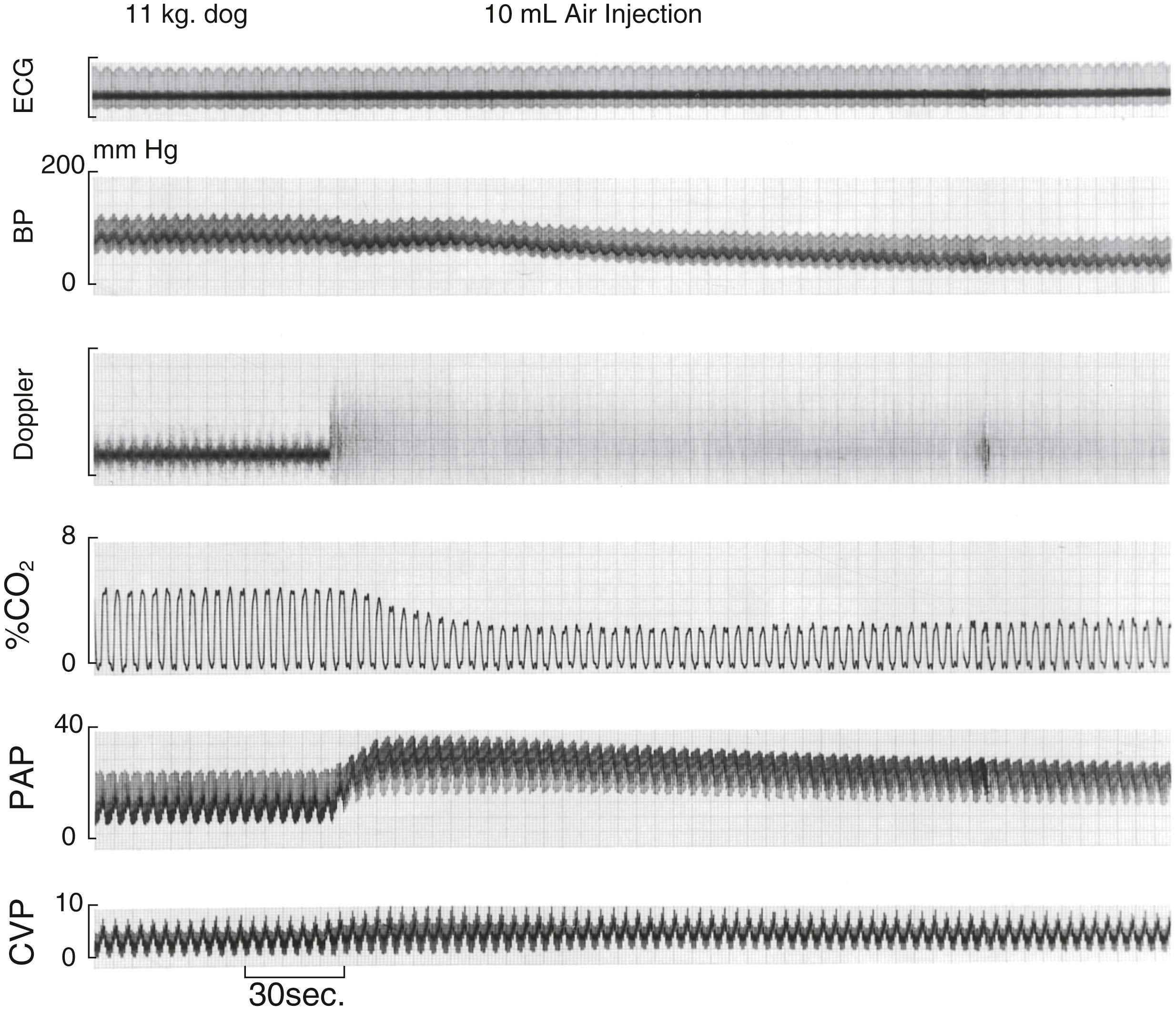 Fig. 57.12, The responses of the electrocardiogram (ECG) , arterial pressure, pulmonary artery pressure (PAP) , pan-tidal CO 2 concentration, a precordial Doppler and central venous pressure (CVP) to the intravenous administration of 10 mL of air over 30 seconds to an 11-kg dog. BP , Blood pressure.