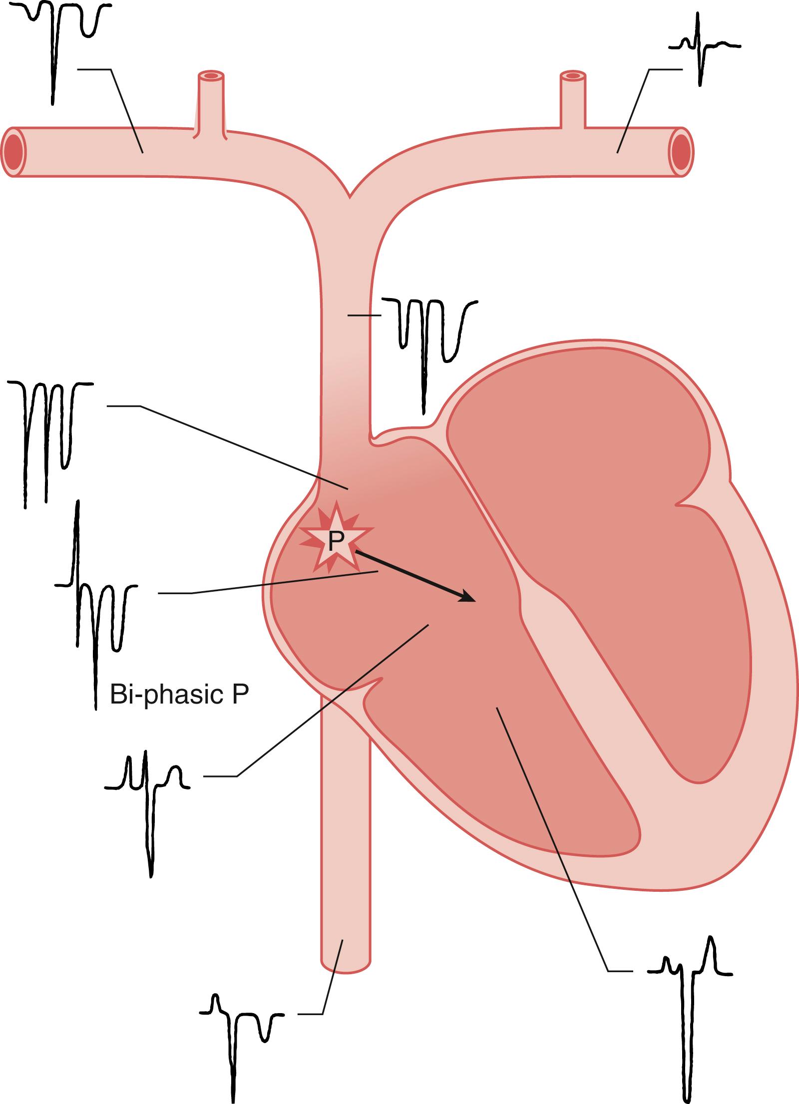 Fig. 57.13, Electrocardiogram (ECG) configurations observed at various locations when a central venous catheter is used as an intravascular ECG electrode. The configurations in the figure will be observed when Lead II is monitored and the positive electrode (the leg electrode) is connected to the catheter. P indicates the sinoatrial node. The black arrow indicates the P-wave vector. Note the equi-biphasic P wave when the catheter tip is in the mid-right atrial position. 101