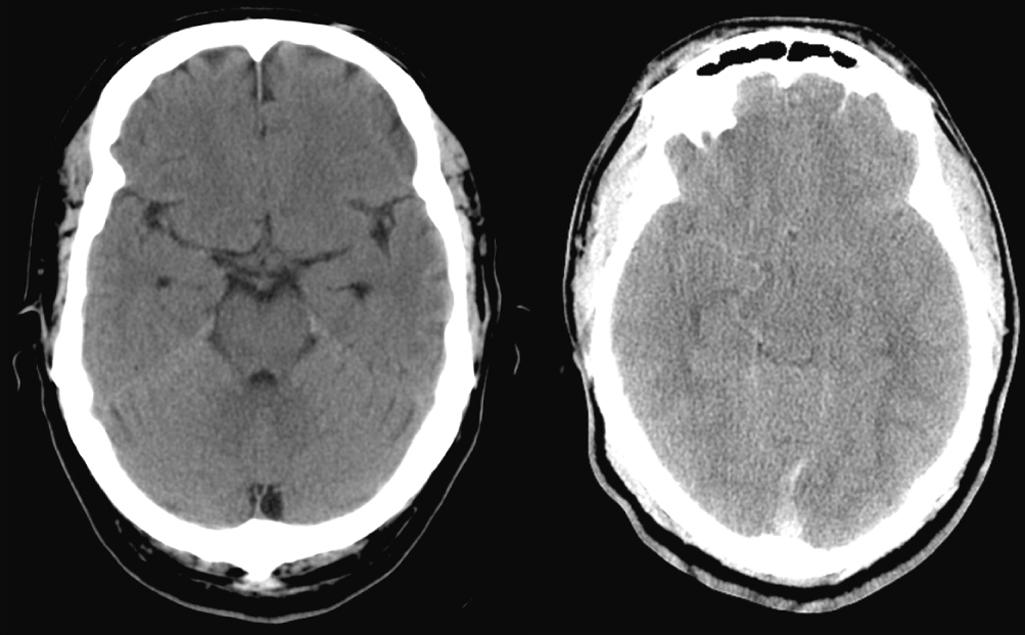 Fig. 57.2, Computed tomography scan depicting normal (left) and compressed (right) basal cisterns. The basal, or perimesencephalic, cerebrospinal fluid space consists of the interpeduncular cistern (anterior), the ambient cisterns (lateral), and the quadrigeminal cisterns (posterior). In the right panel, the cisterns have been obliterated in a patient with diffuse cerebral swelling (caused by sagittal sinus thrombosis).