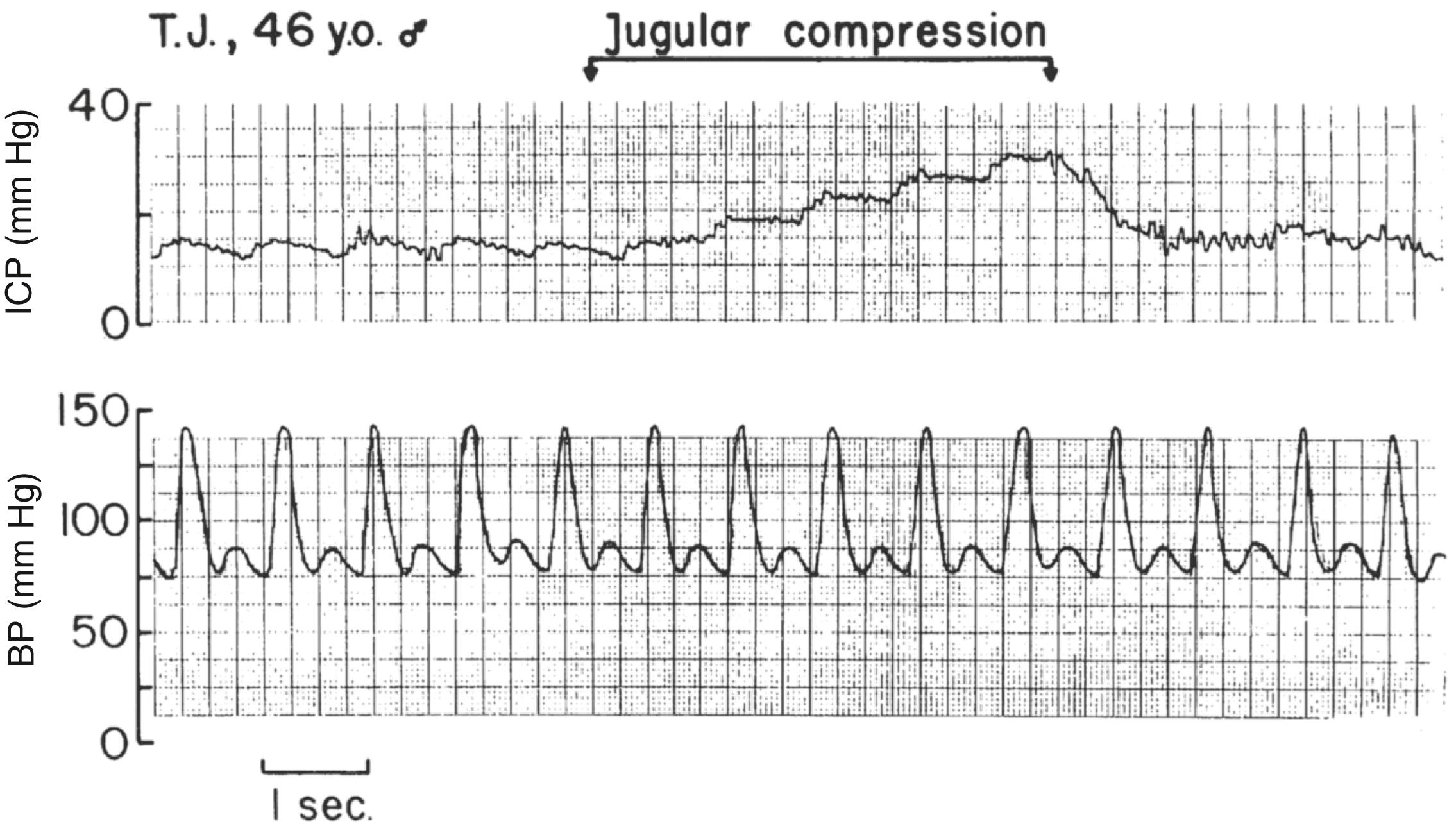 Fig. 57.5, The effect of cerebral venous outflow obstruction on intracranial pressure (ICP) in a patient with an intracerebral hematoma.