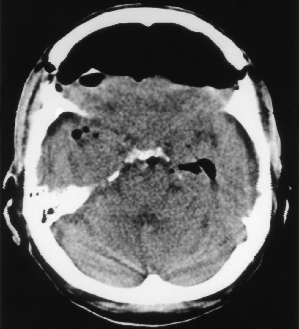 Fig. 57.9, Postoperative computed tomographic scan demonstrating a large pneumocephalus after a subfrontal approach to a suprasellar glioma. Immediately postoperatively, the patient was confused and agitated, and he complained of a severe headache.