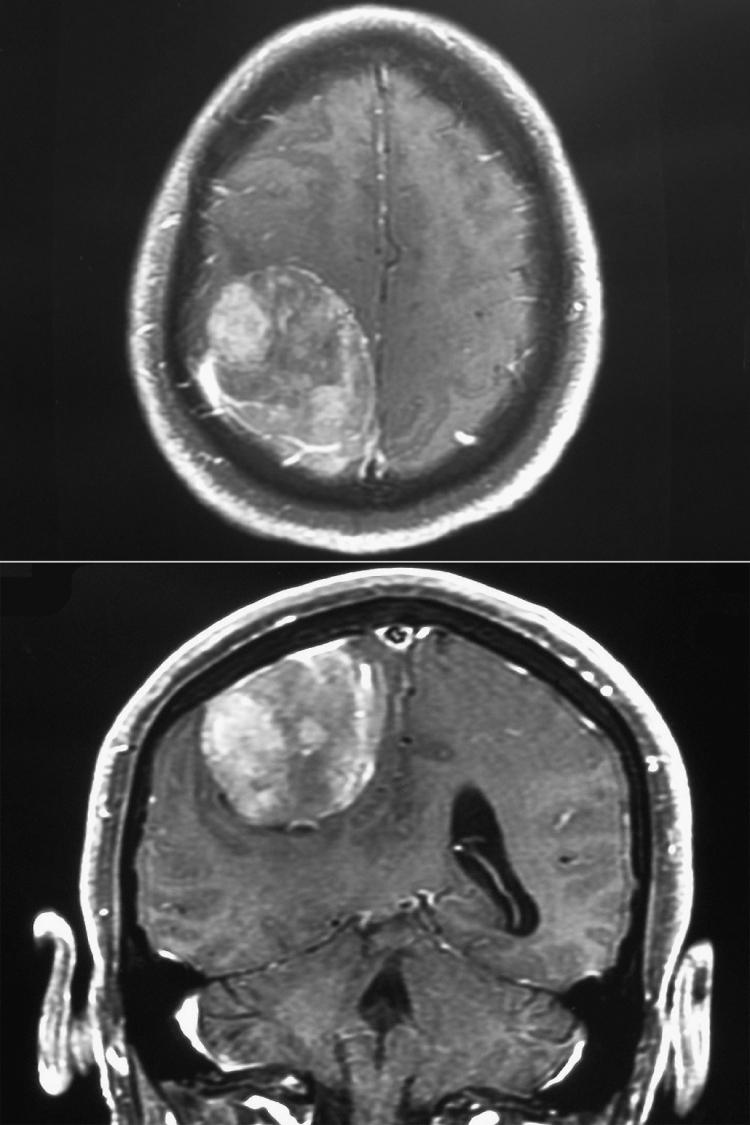 Fig. 57.10, Axial (top) and coronal (bottom) magnetic resonance images of a parasagittal meningioma. Resection of meningiomas arising from the dural reflection overlying the sagittal sinus or from the dura of the adjacent convexity or falx often entails a risk of venous air embolism because of the proximity of the sagittal sinus (the triangular structure at the superior end of the interhemispheric fissure in the bottom panel).