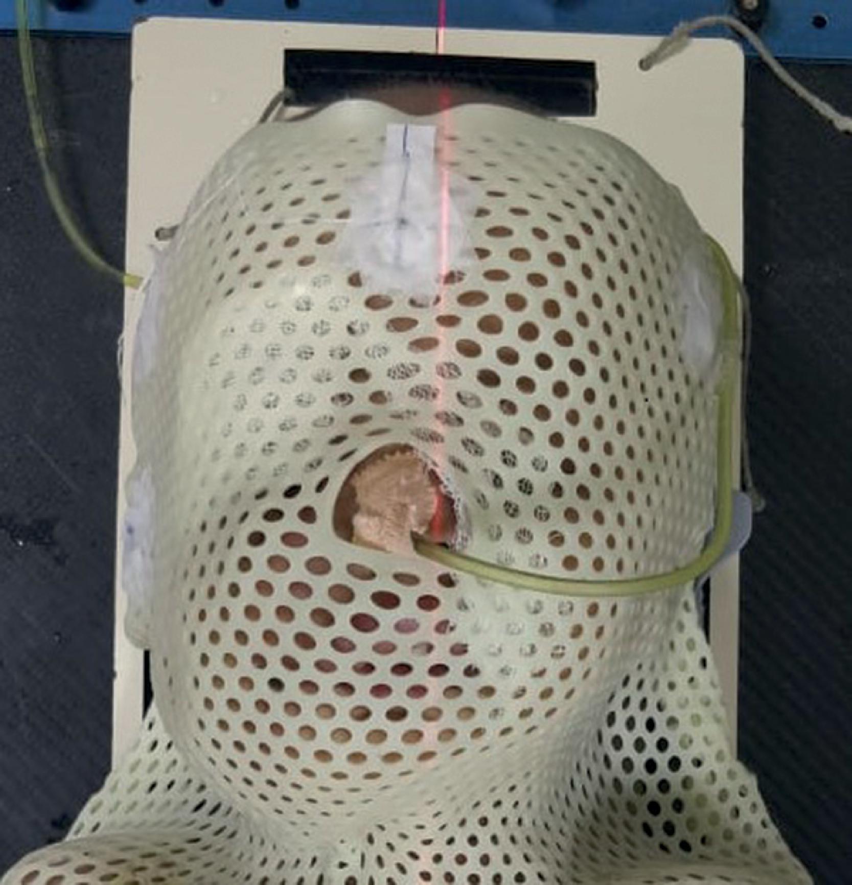 Fig. 49.1, Radiation oncology masks for immobilization and precision delivery of radiotherapy beams making the airway less accessible.