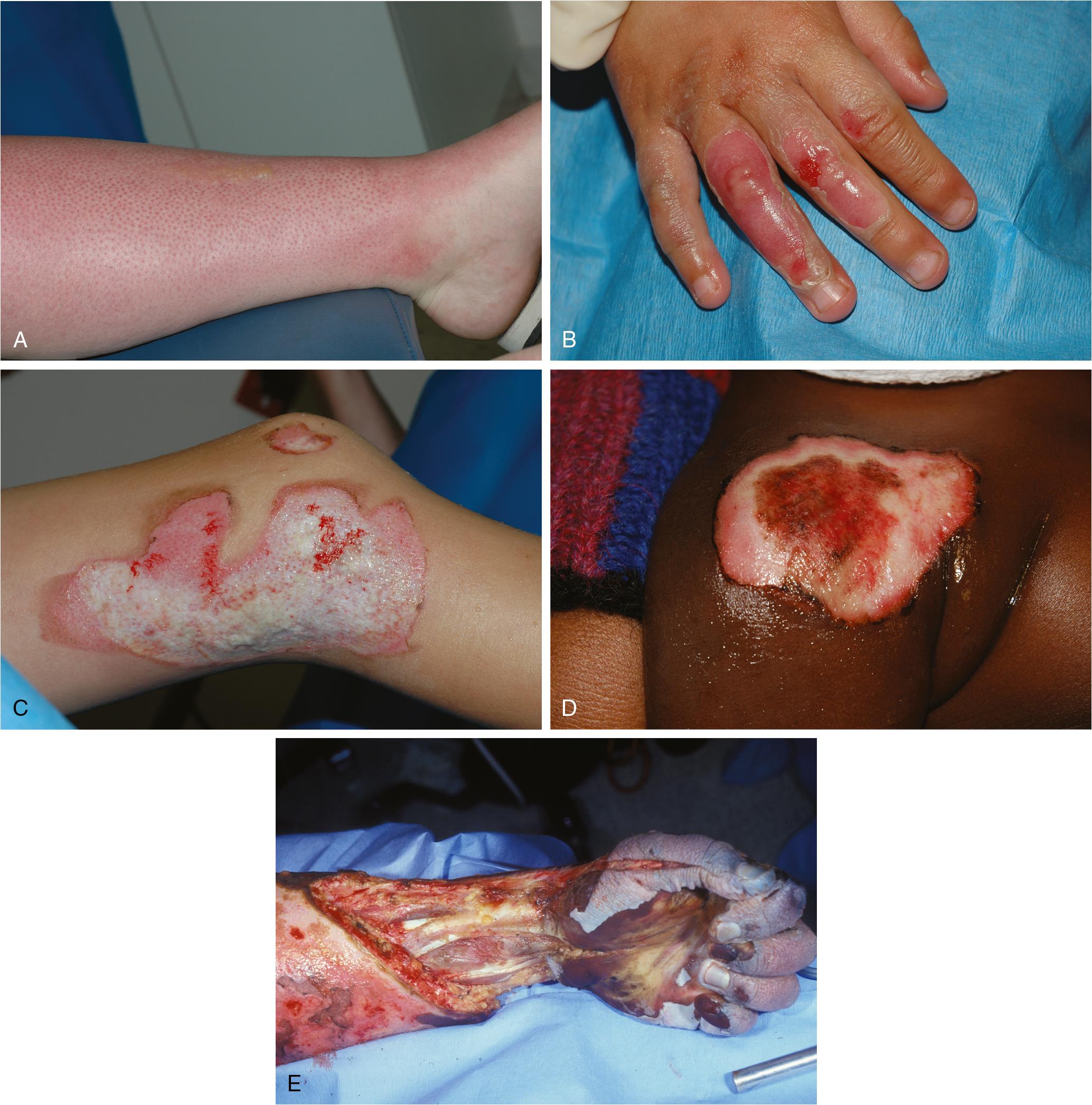 Fig. 41.1, Depth of Thermal Injury.