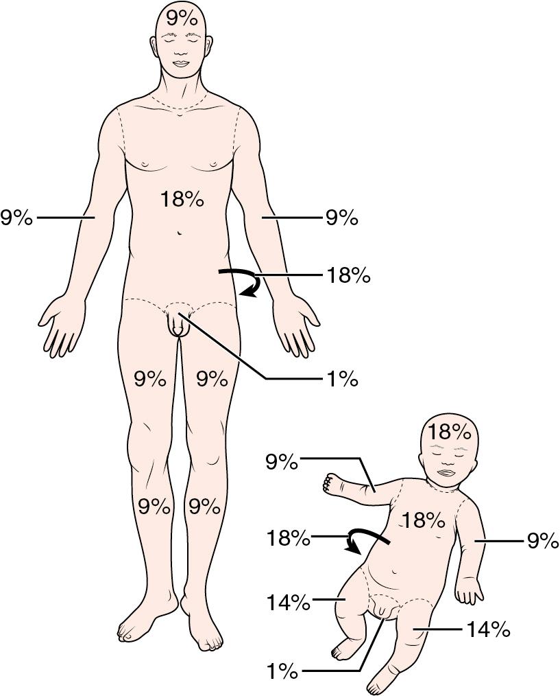 Fig. 41.2, Rule of Nines for Body Surface Area Estimate.