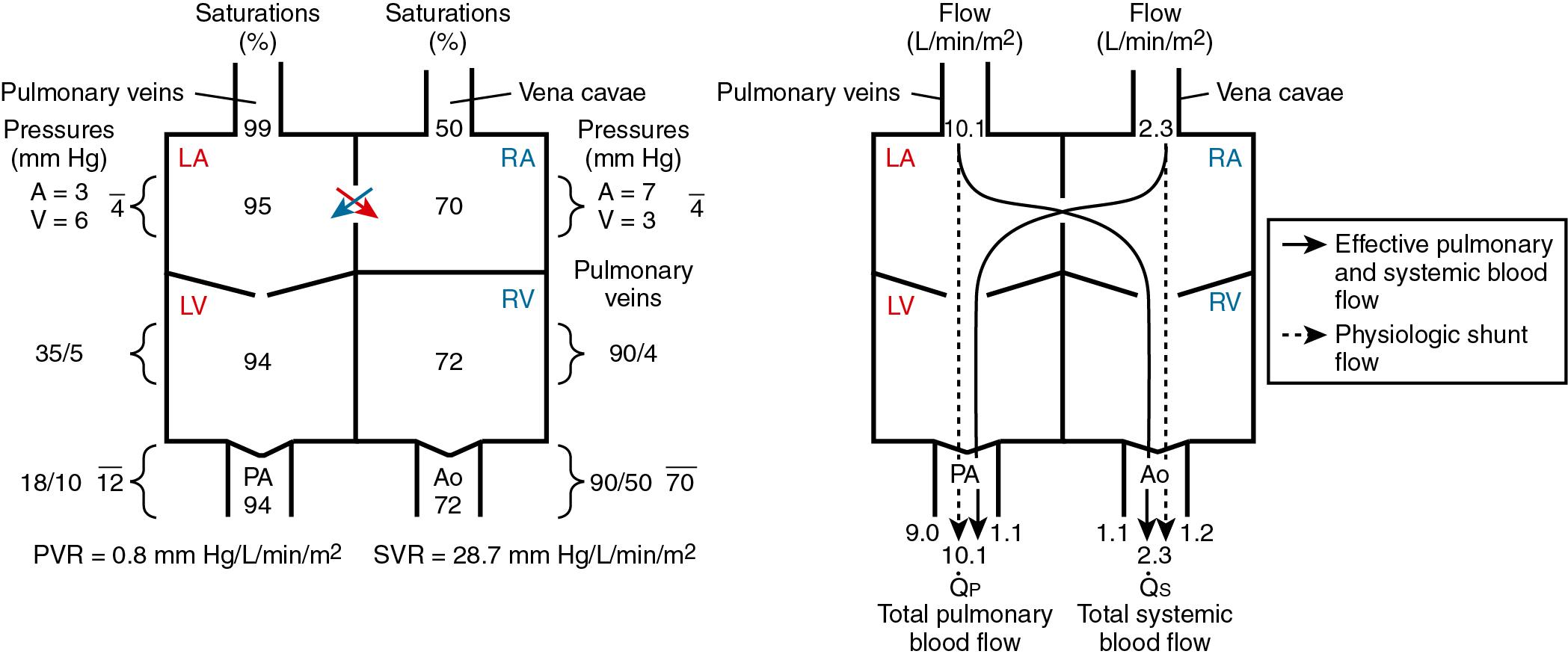 Fig. 30.3, Saturations, Pressures, and Blood Flows in Transposition of the Great Arteries With a Nonrestrictive Atrial Septal Defect and a Small Left Ventricular Outflow Tract Gradient.