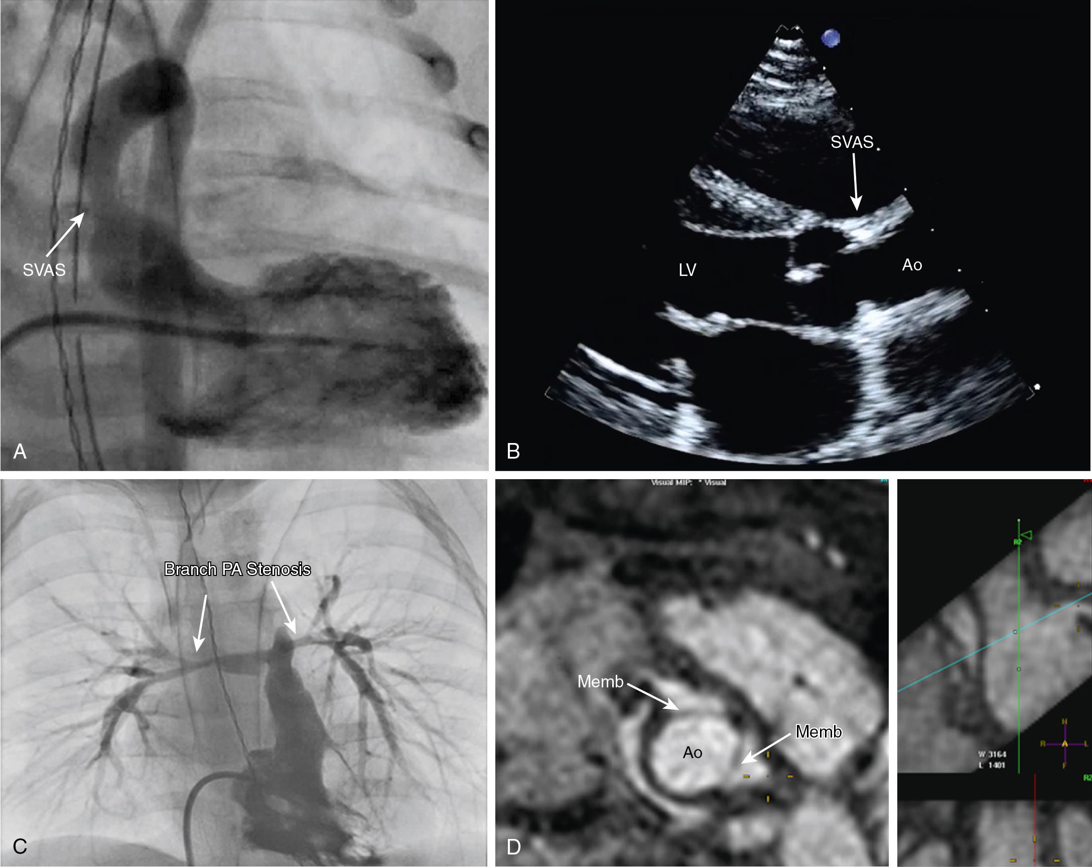 Fig. 30.11, Supravalvar Aortic Stenosis.