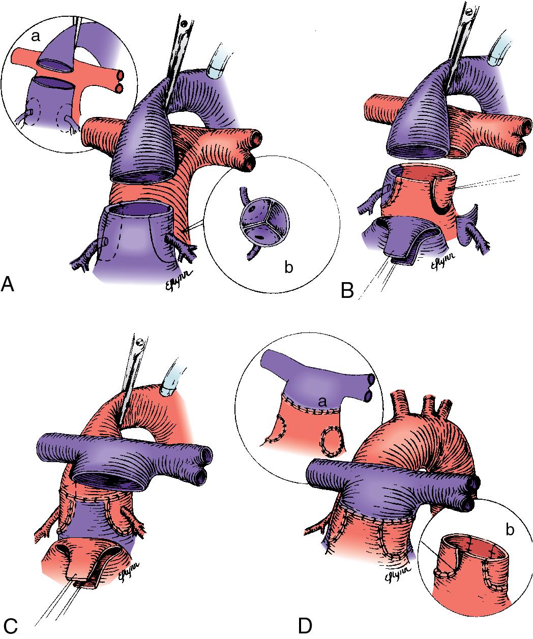 Fig. 30.14, Arterial Switch Procedure.