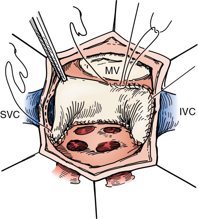 Fig. 30.15, Mustard Procedure (Atrial Switch).