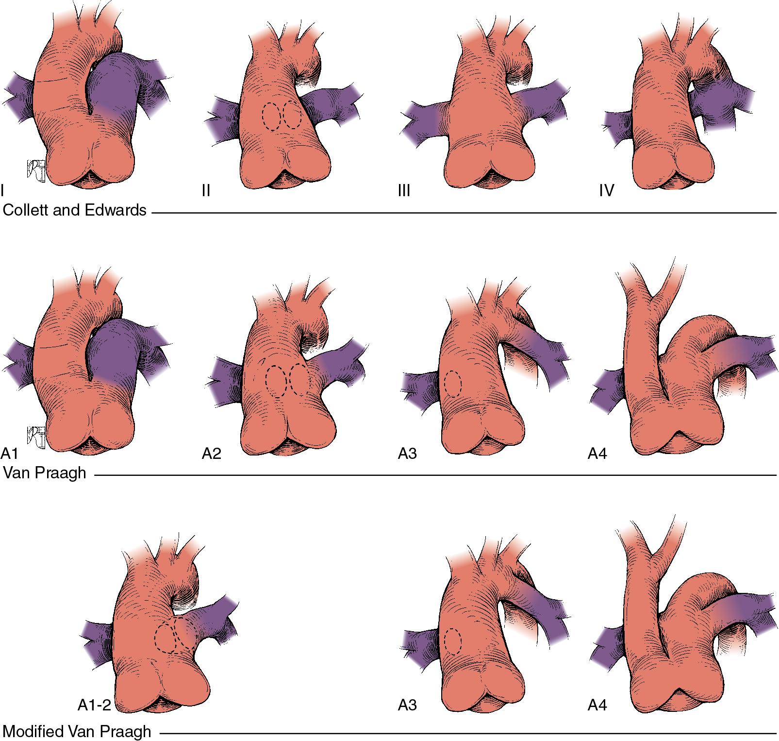 Fig. 30.16, Truncus Arteriosus.