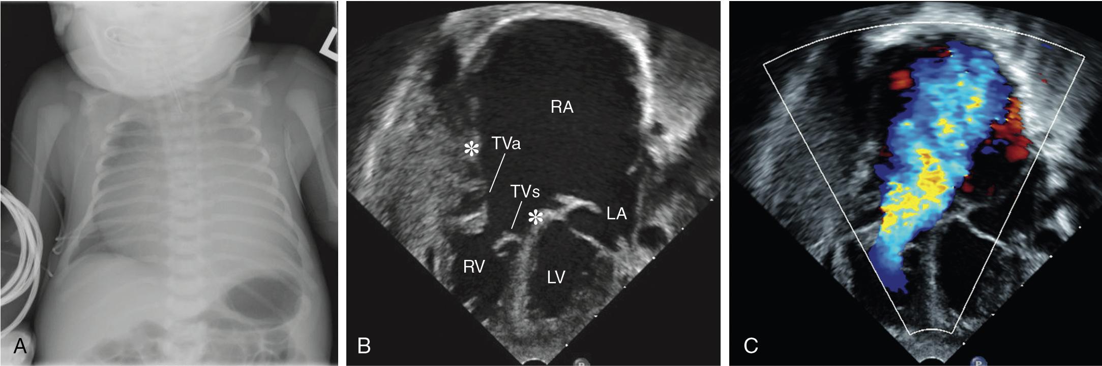 Fig. 30.17, Ebstein Anomaly of the Tricuspid Valve in a Neonate.