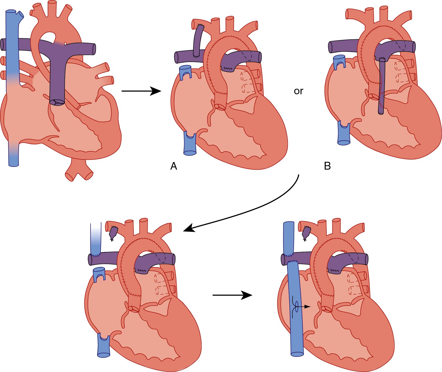 Fig. 30.18, Sequence of Repairs in the Surgical Staging of Hypoplastic Left Heart Syndrome (HLHS) to a Fenestrated Lateral-Tunnel Fontan.