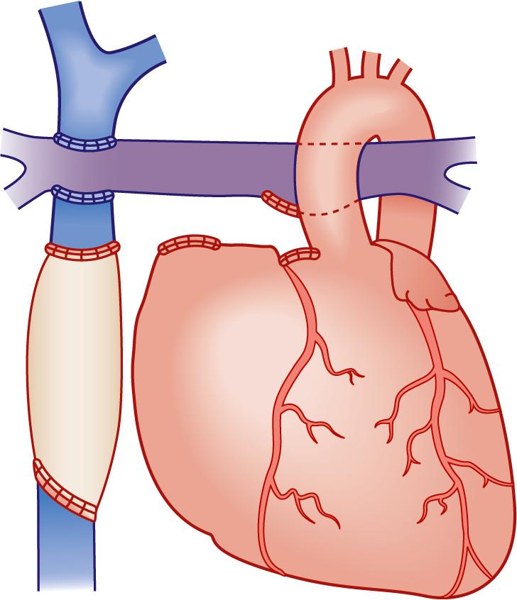 Fig. 30.5, Total Cavopulmonary Connection (Fontan) Using an Extracardiac Conduit or Baffle.