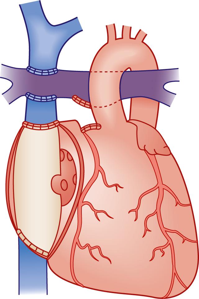 Fig. 30.4, Total Cavopulmonary Connection (Fontan) Using an Intraatrial Lateral Tunnel or Baffle.