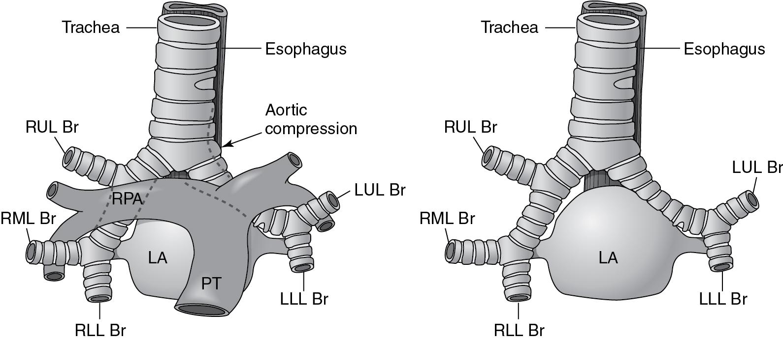 Fig. 30.e1, Relationship of the Pulmonary Arteries to the Tracheobronchial Tree.
