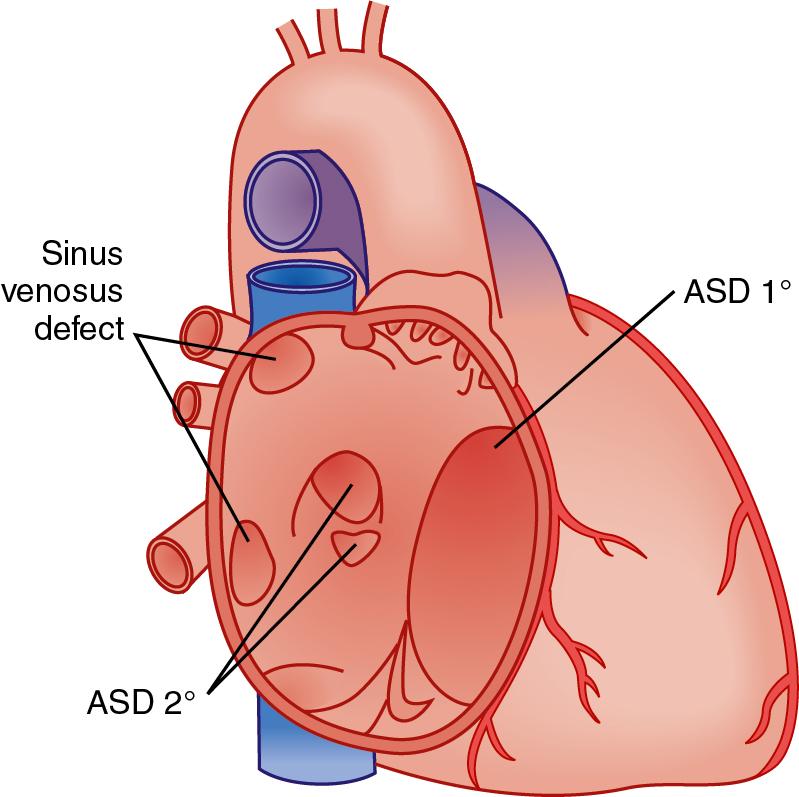 Fig. 30.6, Location of Atrial Septal Defects (ASDs).