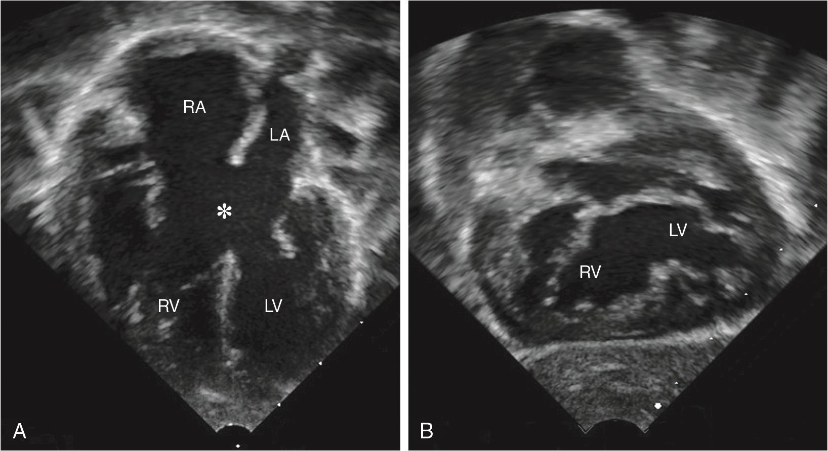 Fig. 30.8, Complete Common Atrioventricular Canal Defect.