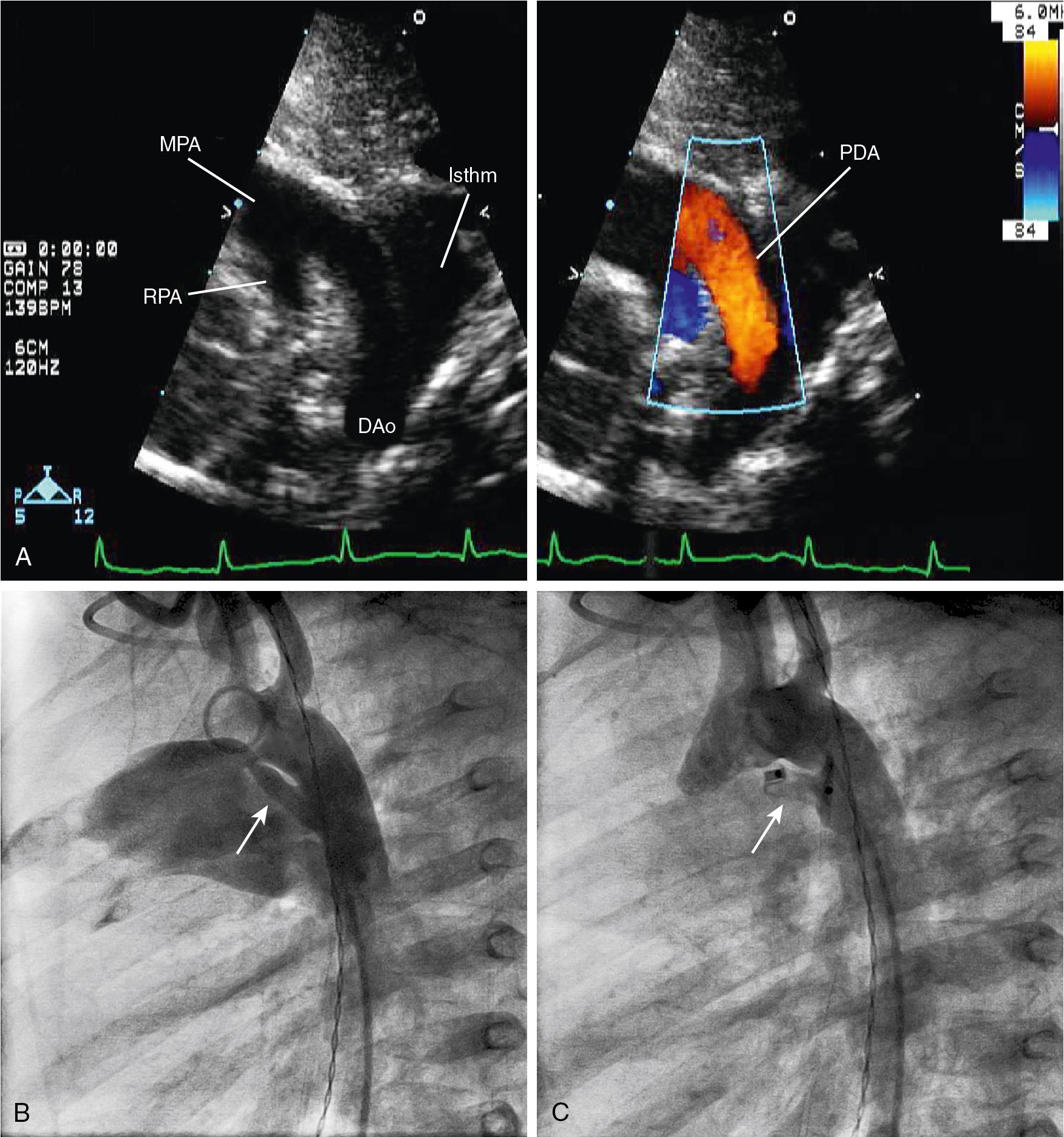 Fig. 30.9, Patent Ductus Arteriosus.