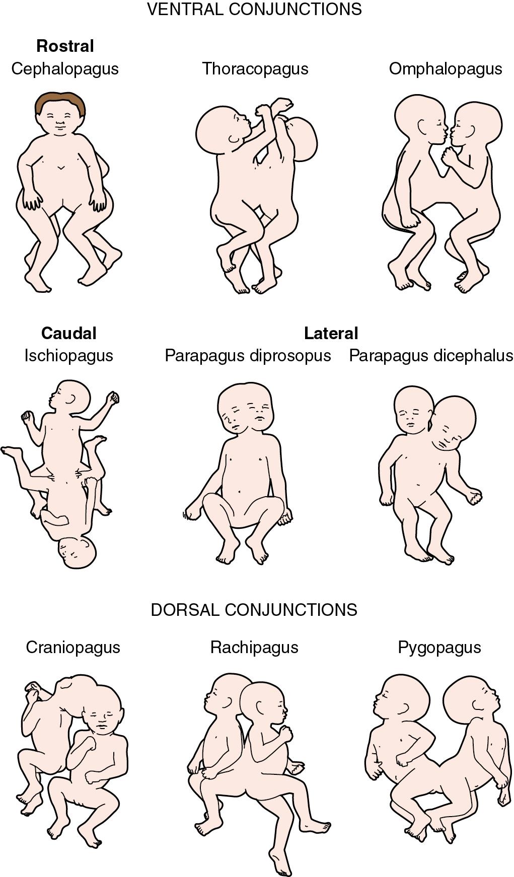 Fig. 39.2, Illustrations Depicting the Anatomic Relationships of the Different Types of Symmetric Conjoined Twins.