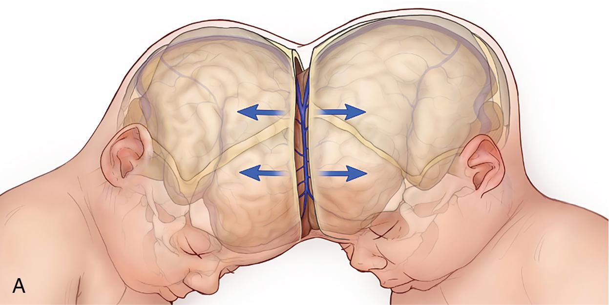 Fig. 39.5, (A) Craniopagus twins in preparation for separation required 3D imaging and subsequent 3D printing of their heads to plan cranial distraction and separation. (B) This image demonstrates how computer-aided modeling can be used to create a 3D printed model of craniopagus twins.