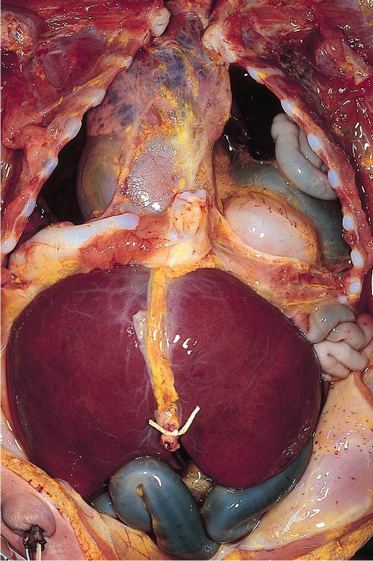 Fig. 28.13, Diaphragmatic Hernia at Postmortem Examination Showing Obliteration of Left Pleural Cavity and Severe Compression of the Heart and Right Lung.