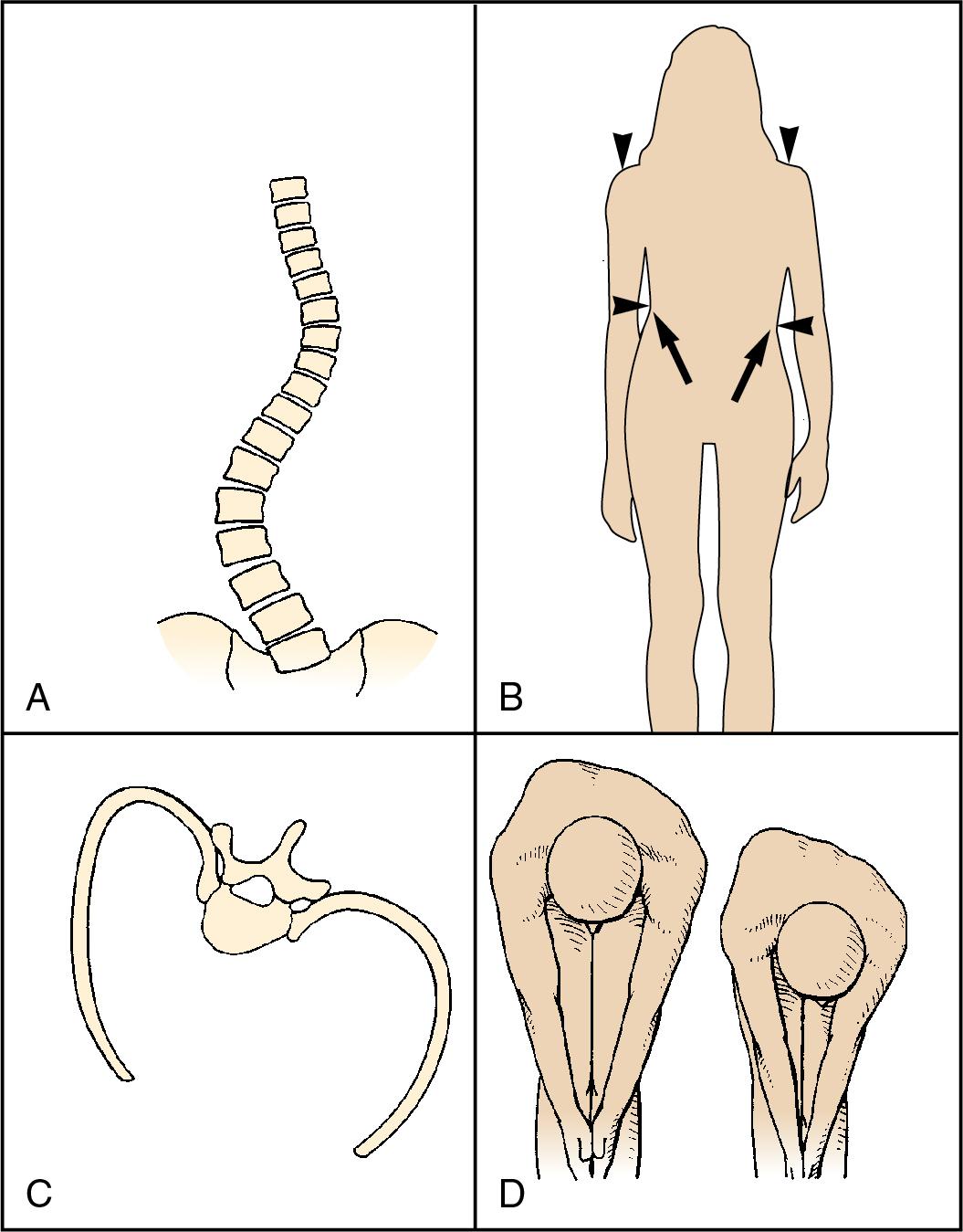 Fig. 36.2, Structural changes in idiopathic scoliosis. A, As curvature increases, alteration in body configuration develops in the primary and compensatory curve regions. B, Asymmetry of shoulder height, waistline, and elbow-to-flank distance are common findings. C, Vertebral rotation and associated posterior displacement of the ribs on the convex side of the curve are responsible for the characteristic deformity of the chest wall in scoliosis patients. D, In the school screening examination for scoliosis, the patient bends forward at the waist. Rib asymmetry of even a small degree is obvious.