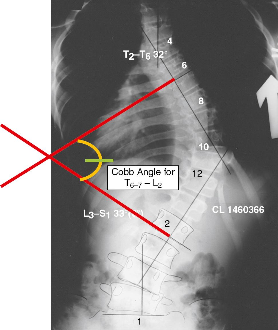 Fig. 36.3, Standing posteroanterior radiograph of a 13-year-old girl with a severe right thoracic section. Notice the Cobb measurement technique. The Cobb angle is derived by drawing lines parallel to the superior surface of the proximal-end vertebra and the inferior surface of the distal-end vertebra. Perpendiculars to these lines are erected and the angle of intersection of these lines is measured. The numbers in parentheses indicate the degree of correction of the deformity on side-bending radiographs.