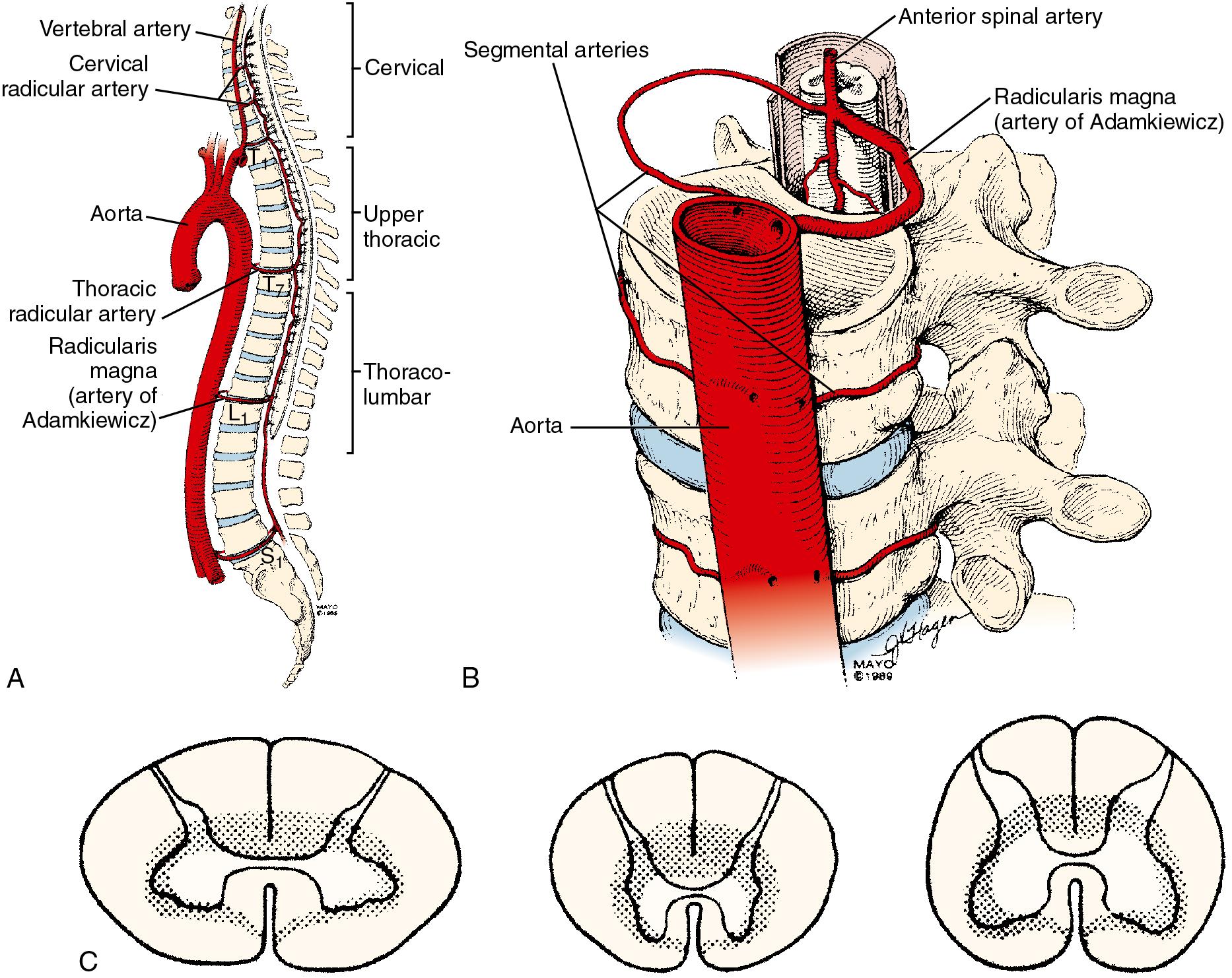 Fig. 36.4, The anatomy of blood flow to the spinal cord is distinctive in the vertical and horizontal distribution. A, Segmental blood flow along the cord axis. B, The thoracic cord depends on flow from a number of thoracic radicular arteries, principally the artery of Adamkiewicz. C, The cross-sectional distribution of blood flow is distinctive. The outer zone of the cord (white matter) is supplied by the radial arteries; the inner zone (gray and white matter) is supplied by the central arteries. Tissue in the shaded region is supplied by both sources.