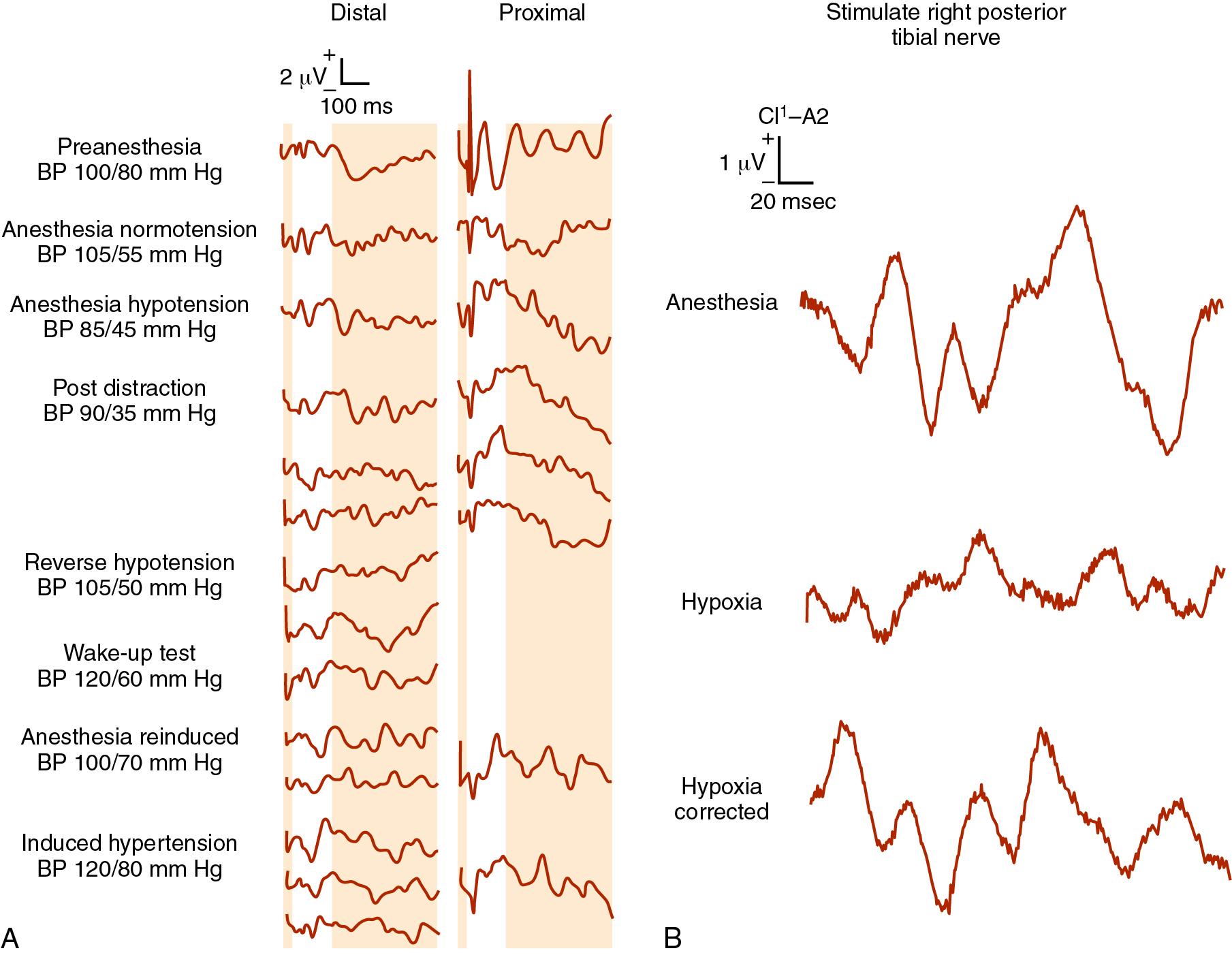 Fig. 36.5, Somatosensory evoked potential (SEPs) change with hypertension and hypoxia. A, During the combination of distraction and hypotension, distal SEPs were unchanged. Resumption of normotension restored the SEP to baseline. B, SEP responses are exquisitely sensitive to hypoxia (P o 2 = 41 mm Hg). Resumption of normoxia restored the SEP to baseline.