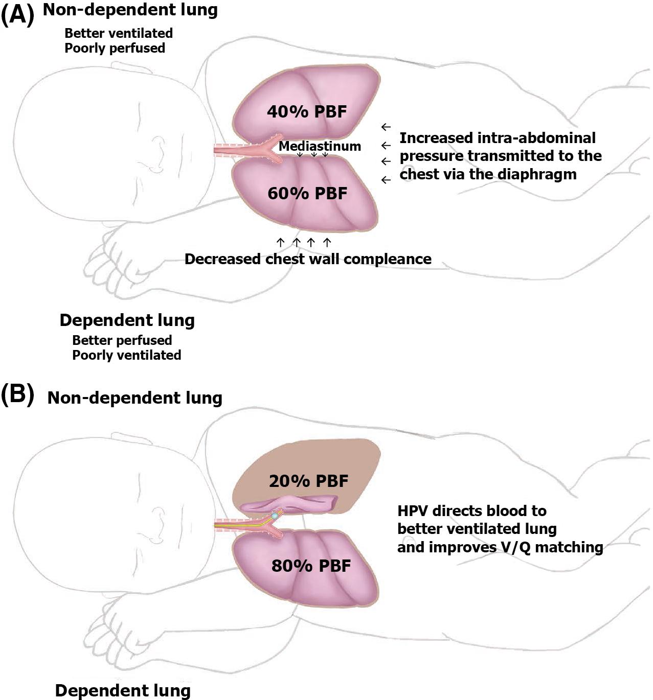 Fig. 32.1, Effects of Lateral Positioning on the Redistribution of Pulmonary Blood Flow and V/Q Mismatch in an Anesthetized Patient.