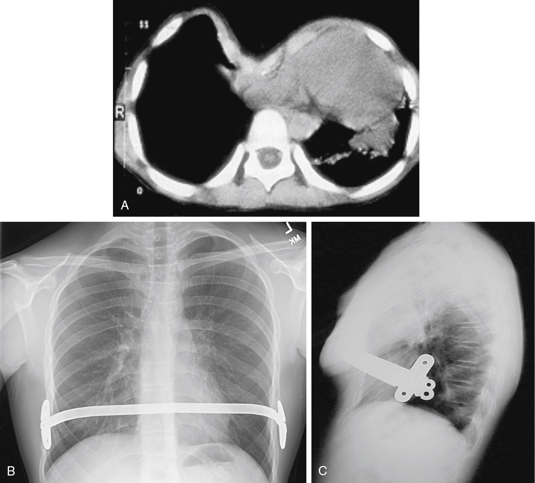 Fig. 32.3, CT scan of a patient undergoing the Nuss procedure ( A ). Anterior-posterior ( B ) and lateral ( C ) radiographs of a patient with a Nuss bar in place.