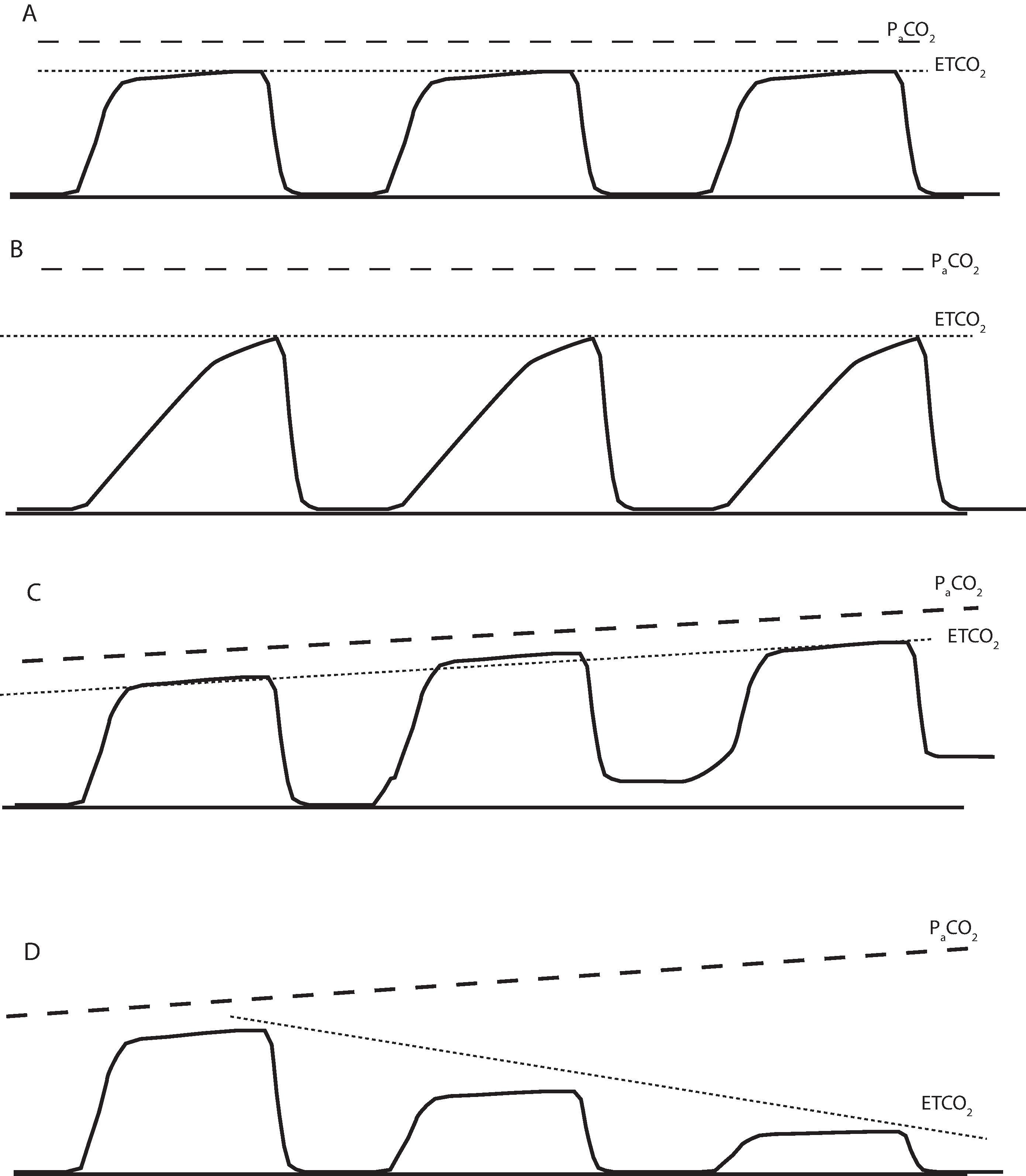 Fig. 20.11, Capnogram Abnormalities. (A) demonstrates a series of normal capnograms. The normal PaCO 2 to ETCO 2 gradient is 2 to 5 mm Hg. Note in (B) the slant of phase II of the capnogram is less steep. This rightward slant of the initiation of the alveolar gas detection can be observed in patients with asthma or chronic obstructive pulmonary disease. The greater the slant to the right (i.e., the lower the slope), the worse the expiratory airway resistance. The gradient of PaCO 2 to ETCO 2 has increased. The waveform in (C) shows a progressive rise in the baseline CO 2 value (i.e., there is a progressive increase in inspiratory carbon dioxide), noting a CO 2 rebreathing most commonly caused by an exhausted CO 2 absorber. (D) signifies a progressive drop in the ETCO 2 (i.e., a decrease in the height of the waveform). This is noted whenever there is an abrupt reduction in pulmonary blood flow (e.g., reduced cardiac output from pulmonary embolism or cardiac arrest).