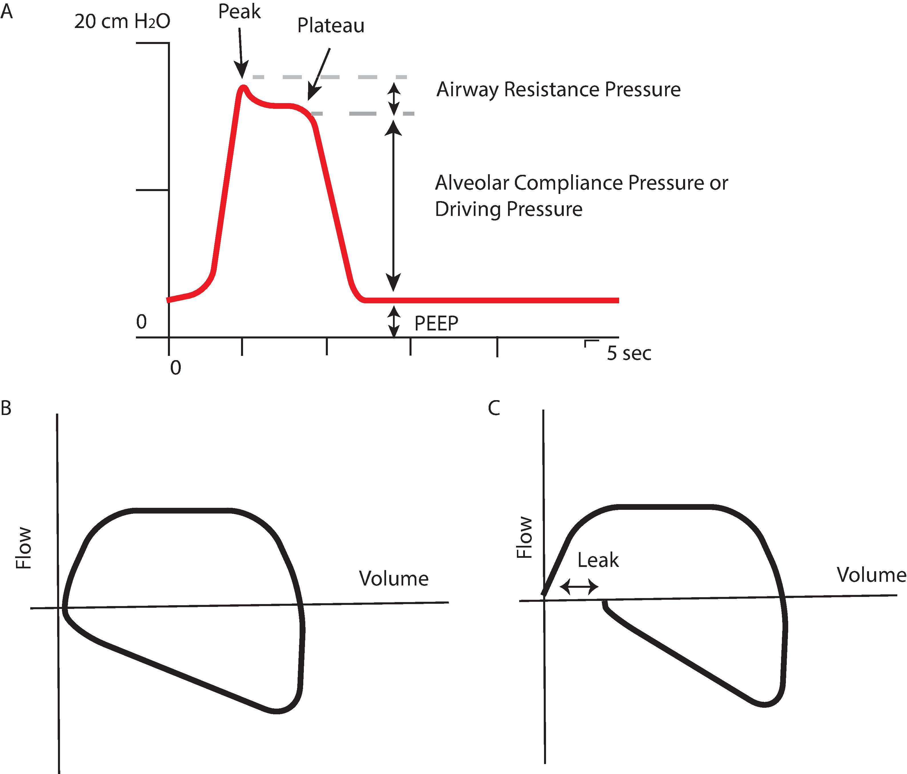 Fig. 20.5, Airway Pressure and Flow Volume. (A) Airway pressure in volume control ventilation with an expiratory pause demonstrates changes in airway pressure and can help determine the etiology of the obstruction. Peak airway pressure or peak inspiratory pressure (PIP) is the highest pressure that occurs inside the lung during inspiration. During an inspiratory pause, there is no air movement, so the airway pressure drops minimally in patients with normal airway resistance and results in a “plateau” in the airway pressure recording, called “plateau pressure.” This plateau pressure reflects the airway pressure in the small airways and alveoli during a breath. The difference between plateau pressure and PEEP is called the “driving pressure.” The difference between the peak and plateau pressure is caused by resistance within the breathing circuit and the patient's airways. When airway pressure increases because of increases in airway resistance, the PIP is affected greater than the plateau (e.g., with bronchospasm, endotracheal tube kinking). If the plateau pressure increases, other processes reducing lung or chest wall compliance (e.g., pulmonary edema, pneumothorax, increased tidal volume) may be the cause. Flow volume loops can also be evaluated for changes in ventilator parameters (B). For example, when there is a circuit leak (C), the expiratory portion of the flow volume loop will fail to return to the starting point.