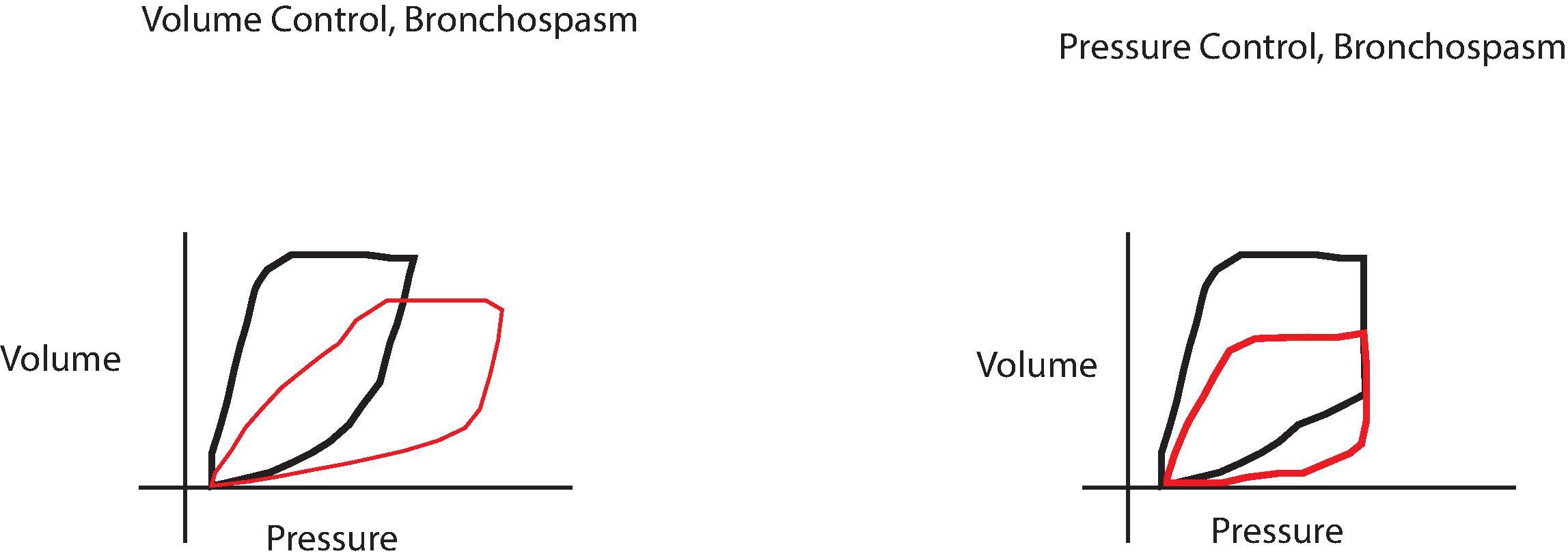 Fig. 20.8, Bronchospasm. With volume control ventilation (A), the set tidal volume is attempted to be delivered, with an increase in pressure. This results in the pressure volume loop being shifted to the right and flattened. In pressure control ventilation (B) the increased airway resistance of the lung results in a decreased tidal volume, without a change in the pressure (because that is the ventilator set point). Normal lungs, black tracing; bronchospasm, red tracing.