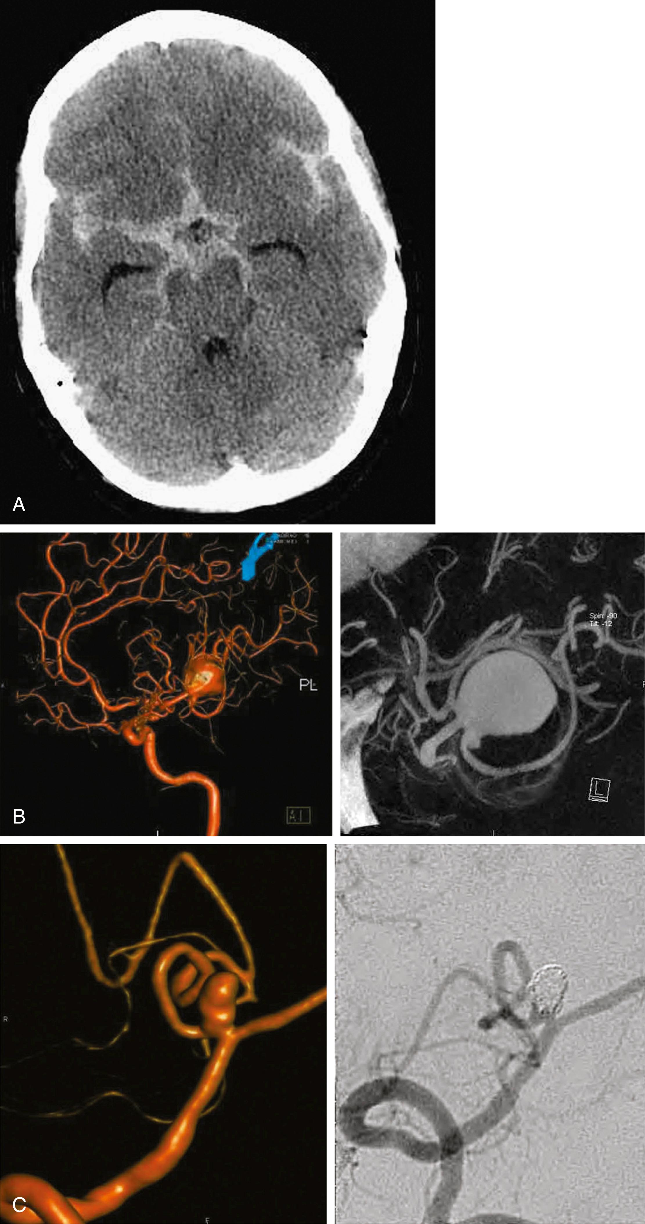 Fig. 29.1, (A) A non–contrast-enhanced head computed tomography (CT) scan reveals extensive subarachnoid hemorrhage in the basal cisterns, sylvian fissures, and anterior interhemispheric fissure in a patient with a ruptured left posterior communicating artery aneurysm. There is also prominence of the temporal horns of the lateral ventricles, suggesting hydrocephalus. (B) Left, Three-dimensional reconstruction angiogram (oblique anterolateral view) showing giant left middle cerebral artery bifurcation aneurysm, with several branches arising from aneurysm body. Right, CT angiogram of the same aneurysm (left lateral view) . (C) Left, Three-dimensional reconstruction angiogram showing a multilobed right posterior inferior cerebellar artery aneurysm. Right, Angiogram (anteroposterior right vertebral injection) showing coil occlusion of a posterior inferior cerebellar artery aneurysm.