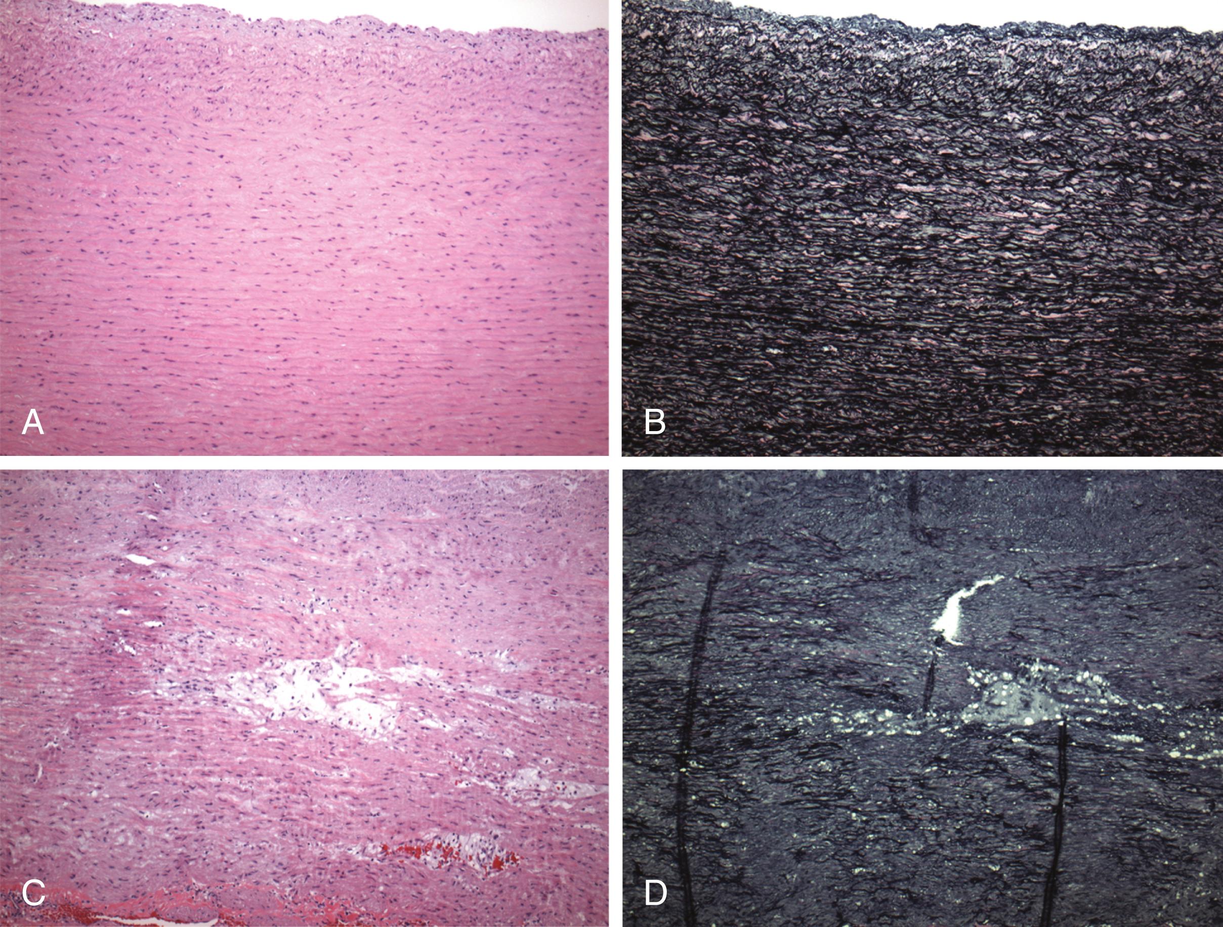 Figure 141.1, ( A and B ) Photomicrographs illustrating the regular and parallel nature of the elastic lamellae found within the media of the normal ascending aorta. The lamellae are composed of elastic fibers running in parallel with intervening smooth muscle, ground substance, and collagen. The Verhoeff–van Gieson (VVG) stain highlights these major elastic fibers (black) (A, hematoxylin-eosin [H&E], ×100; B, VVG, ×100). ( C and D ) Photomicrographs showing profound fragmentation of the elastic fibers, with spaces left within the media of the ascending aorta. Though often referred to as cystic medial degeneration, the spaces created by this fragmentation lack a lining and hence are not truly “cysts.” These spaces often contain increased amounts of glycoproteins. The VVG stain further highlights the severe elastic fiber (black) fragmentation. The vertical black lines are fixation artifacts from folding of the elastic sheet (C, H&E; D, VVG).