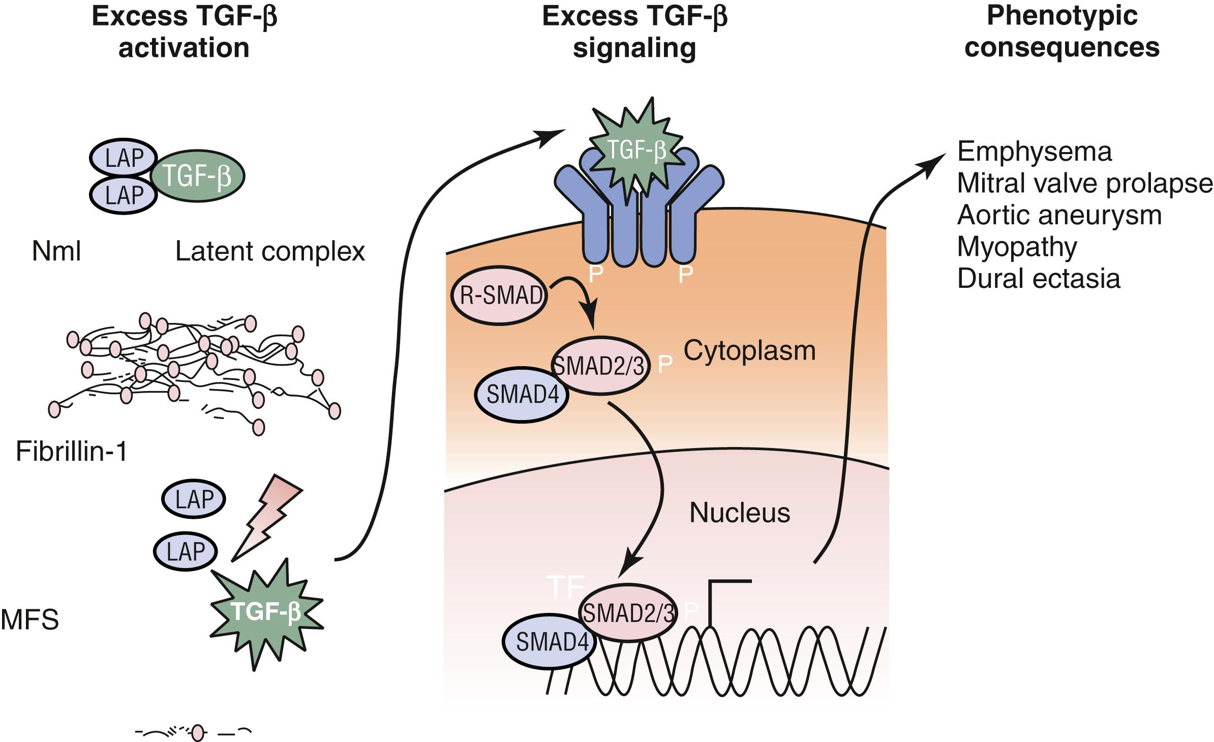 Figure 141.2, Excess activation of transforming growth factor-β (TGF-β) causes many of the features of Marfan syndrome. Normal TGF-β metabolism requires binding of the cytokine to several proteins, including microfibrils, to prevent excess signaling. In Marfan syndrome, lack of normal microfibrillar assembly allows TGF-β to remain unsequestered in the extracellular space. As a consequence, excess TGF-β signaling can occur on the cell surfaces of TGF-β receptors. Once the TGF-β binds to its receptor, downstream receptor–associated SMAD proteins translocate to the nucleus to modulate transcriptional activity, alter protein expression, and yield phenotypic change .