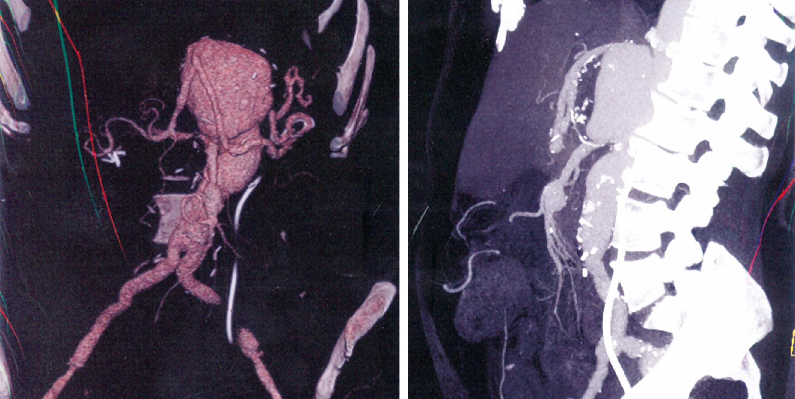 Figure 141.4, Ten-centimeter visceral patch aneurysm 7.5 years after a type II thoracoabdominal aortic aneurysm repair in a 48-year-old woman with Marfan syndrome. A hybrid open/endovascular stent-graft approach was used to repair the region. VRT reconstruction (left) ; lateral view demonstrating effacement of distance between superior mesenteric artery and celiac axis (right) .