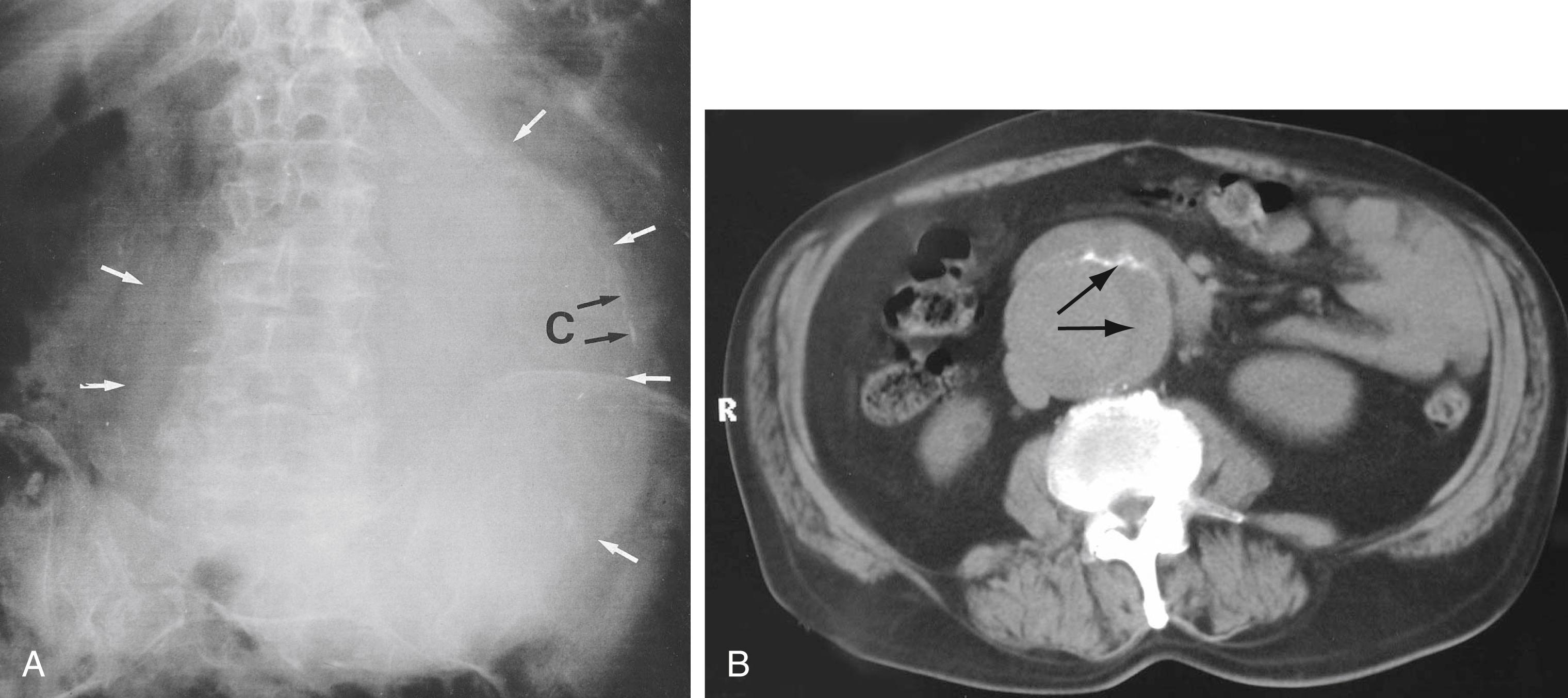 Fig. 42.2, Abdominal Aortic Aneurysm (AAA).