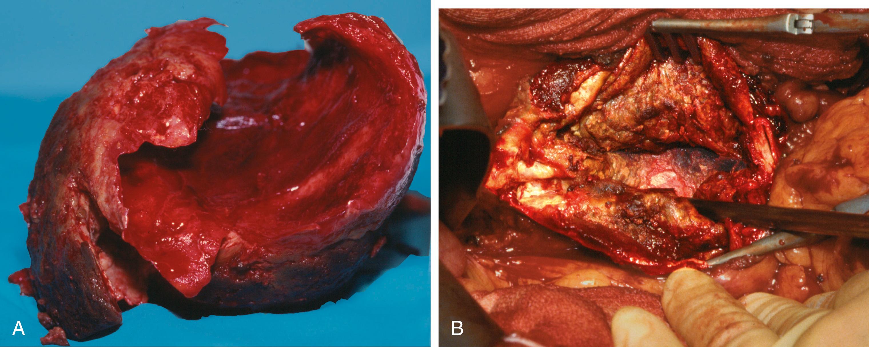 Fig. 42.3, Abdominal Aortic Aneurysm.