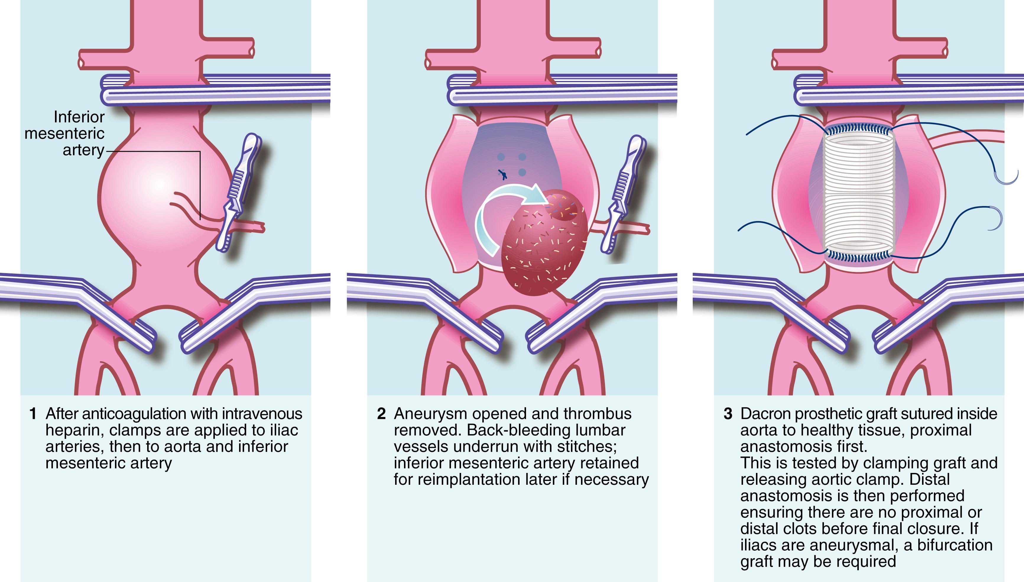 Fig. 42.4, Technique of open Abdominal Aortic Aneurysm Surgery.