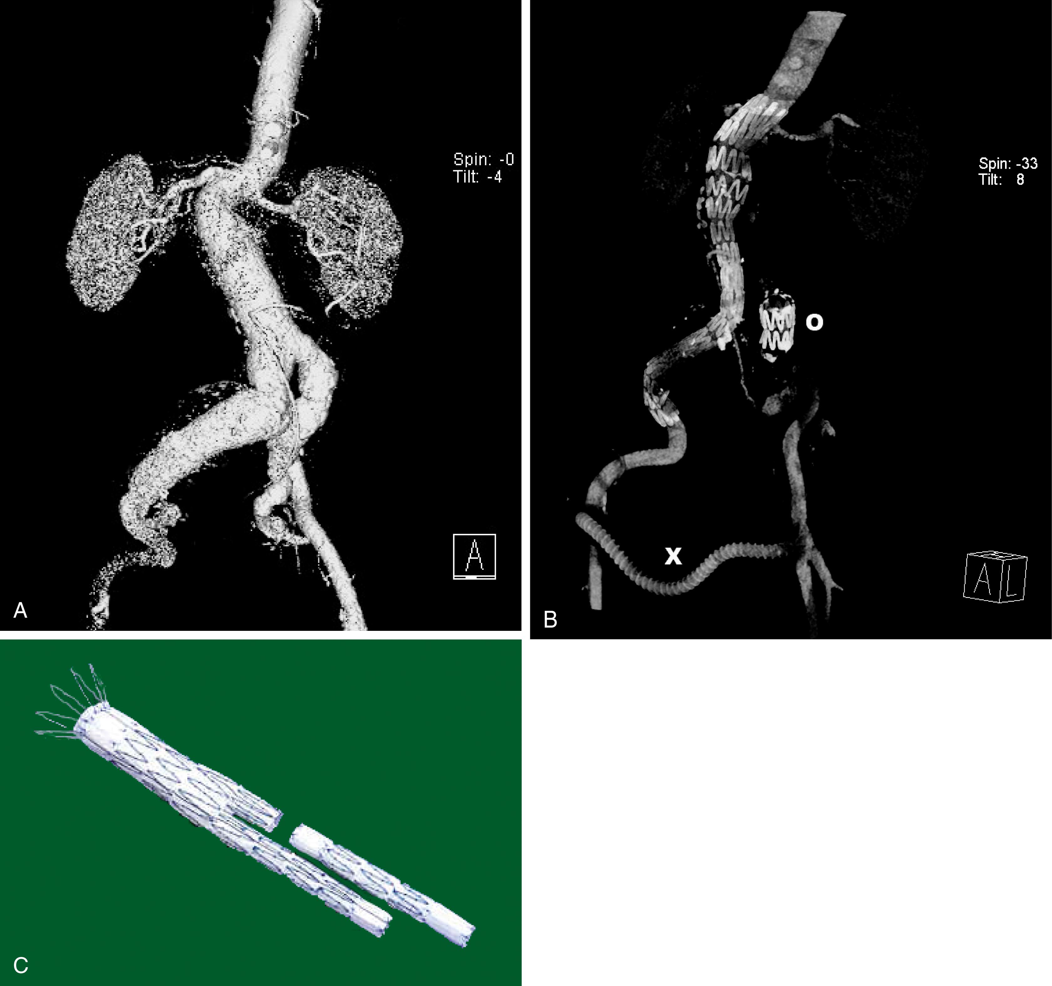 Fig. 42.5, Endovascular Aneurysm Repair.