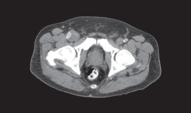 FIG 47.1, CT angiography showing a right femoral artery aneurysm.