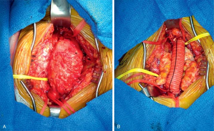 FIG 47.2, Femoral artery aneurysm before (A) and after (B) interposition graft with Dacron.