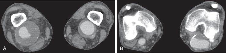 FIG 47.3, CT Angiography of bilateral lower extremities. Axial images demonstrate bilateral popliteal artery aneurysms (A and B).