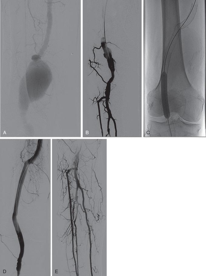 FIG 47.4, Endovascular repair of popliteal artery aneurysm with covered stent. (A) Angiogram demonstrating aneurysm of the above-knee popliteal artery. (B) Angiogram demonstrating three-vessel runoff. (C) Image of the popliteal artery poststent deployment; the calcified, excluded aneurysm is visualized. (D) Angiogram demonstrating exclusion of the popliteal artery aneurysm. (E) Angiogram demonstrating preservation of three-vessel runoff after repair.