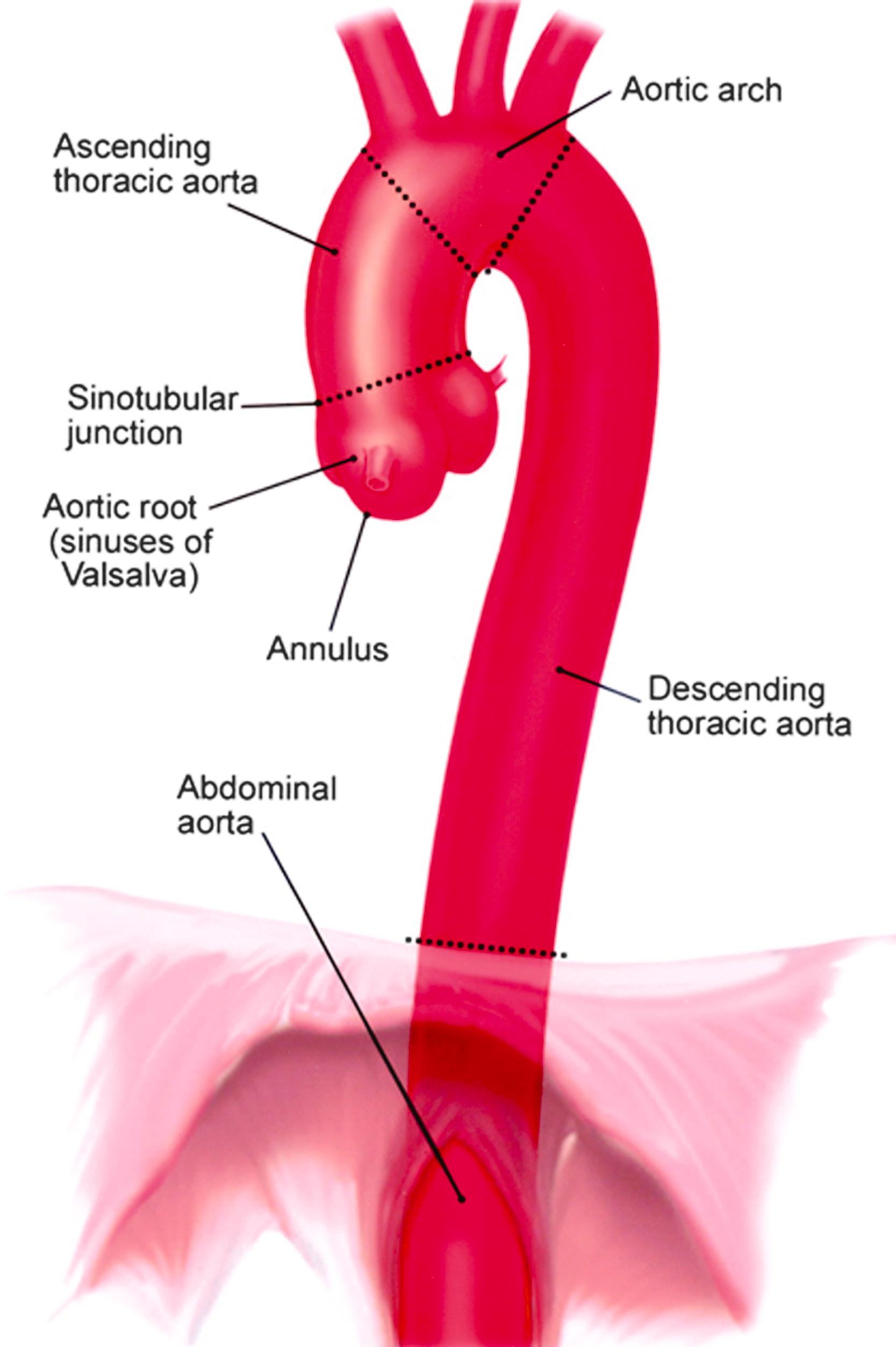 Figure 9.1, Anatomy of thoracic and proximal abdominal aorta (Massachusetts General Hospital Thoracic Aortic Center). [12] .