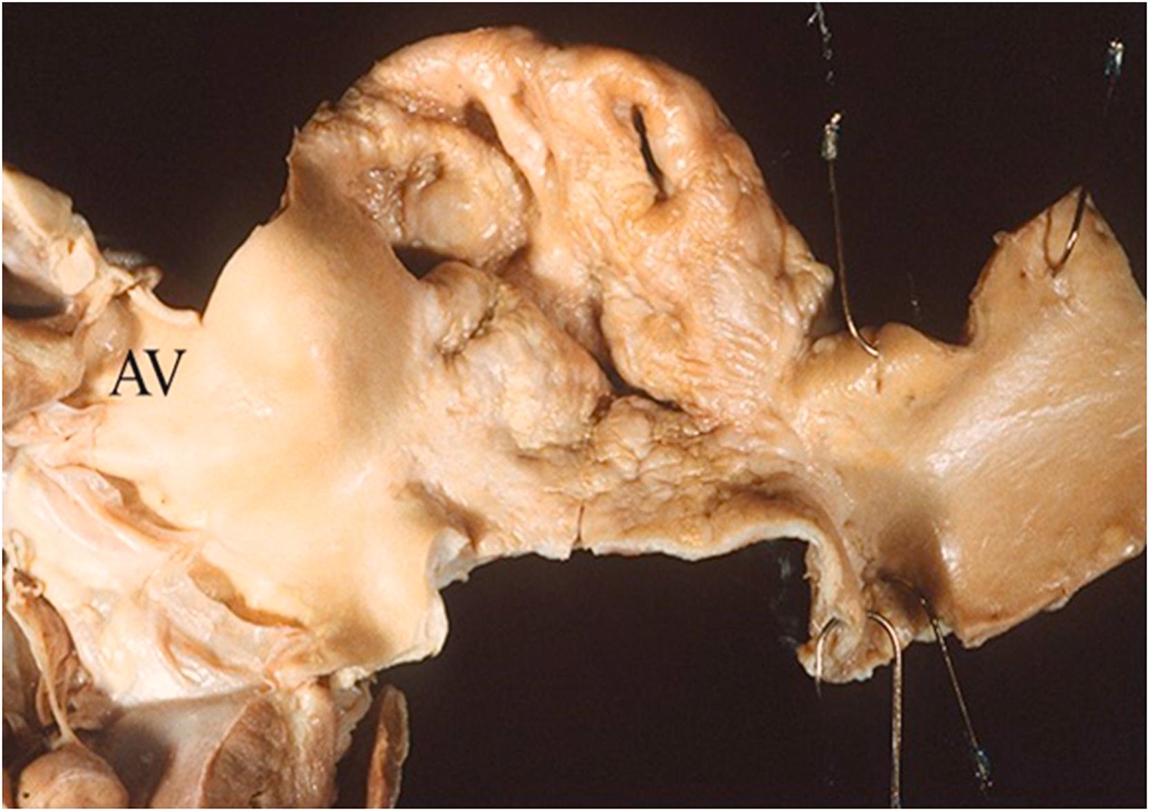 Figure 9.11, Gross image of Takayasu’s aortitis showing skip lesion with wrinkled intimal appearance of the arch of the aorta ( AV , aortic valve).