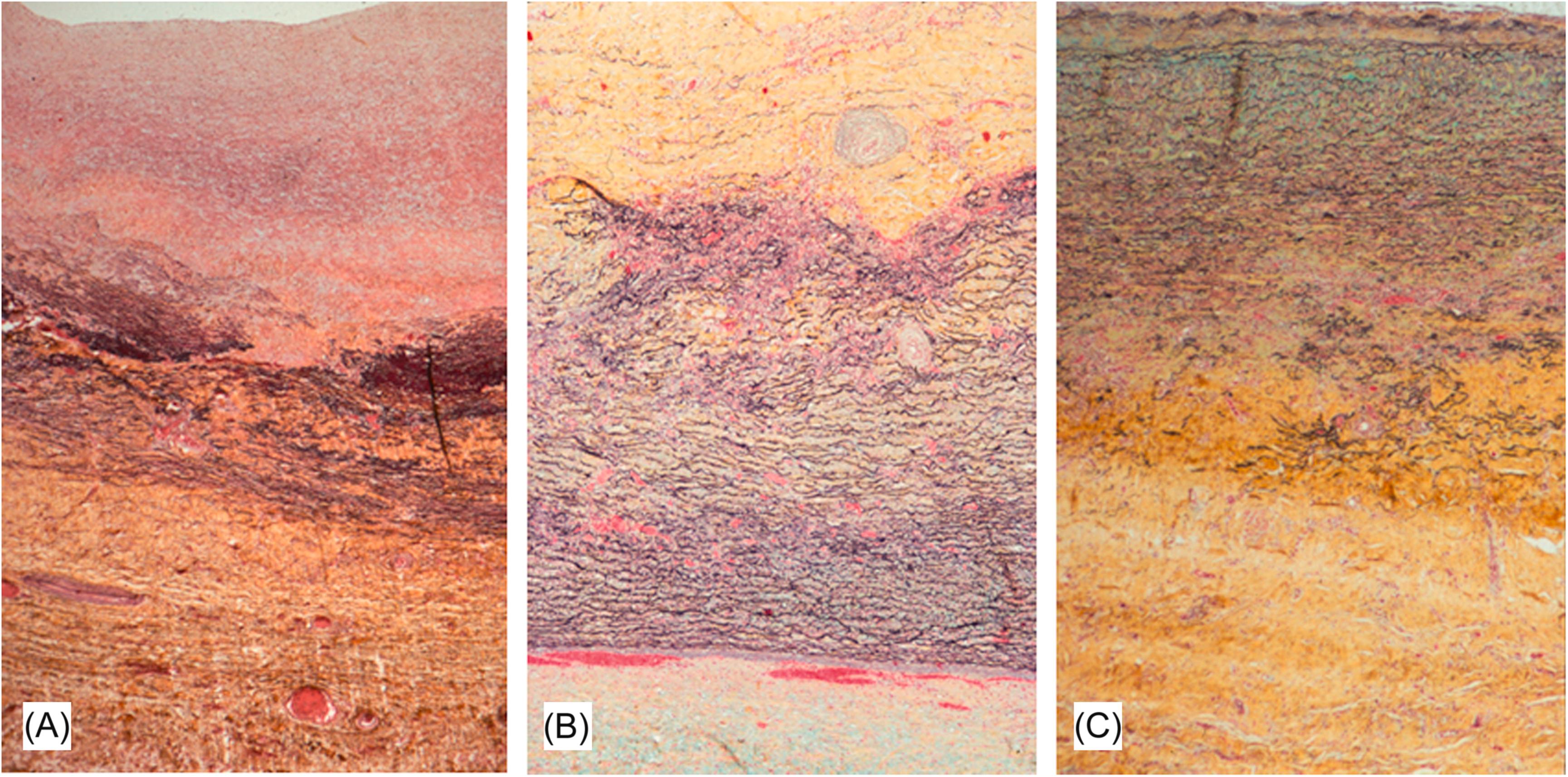 Figure 9.12, (A) Takayasu’s aortitis, burned-out lesion. Note fibrointimal thickening, medial destruction, thinning (central dark area), and adventitial thickening (bottom). The media is focally replaced by fibrous tissue, but no inflammation is identified. (B) Takayasu’s involvement of the aorta. The disease in this case and that illustrated in (C) also involved the pulmonary artery. (C) Section with the media of the aorta showing focal destruction of the elastic lamellae caused by a chronic inflammatory infiltrate (all Movat pentachrome stain).